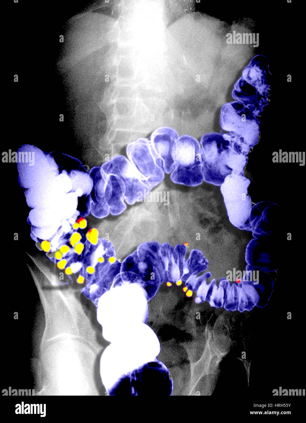 Enema de bario mostrando Diverticulosis Foto de stock