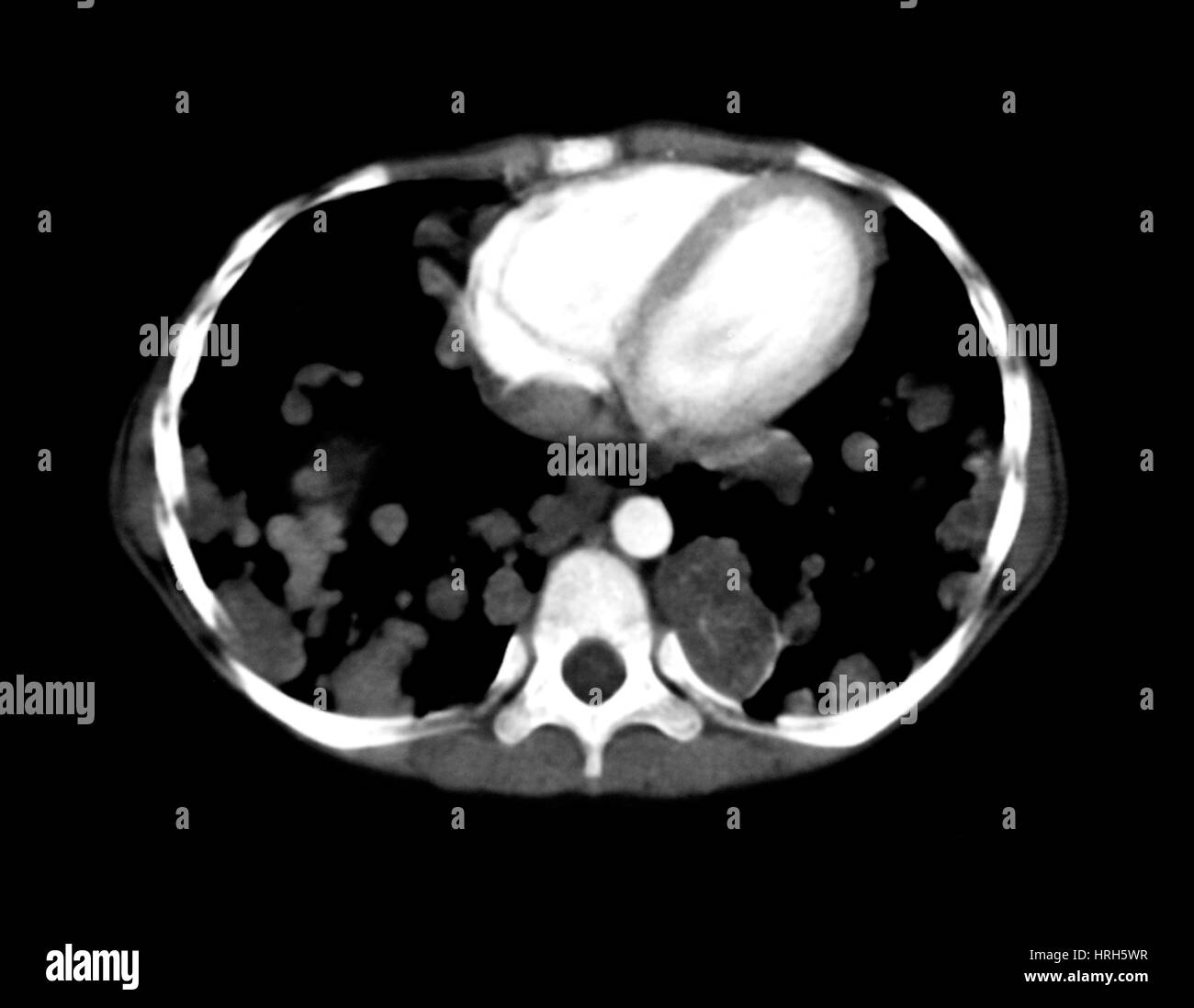 Enfermedad metastásica de los pulmones Foto de stock