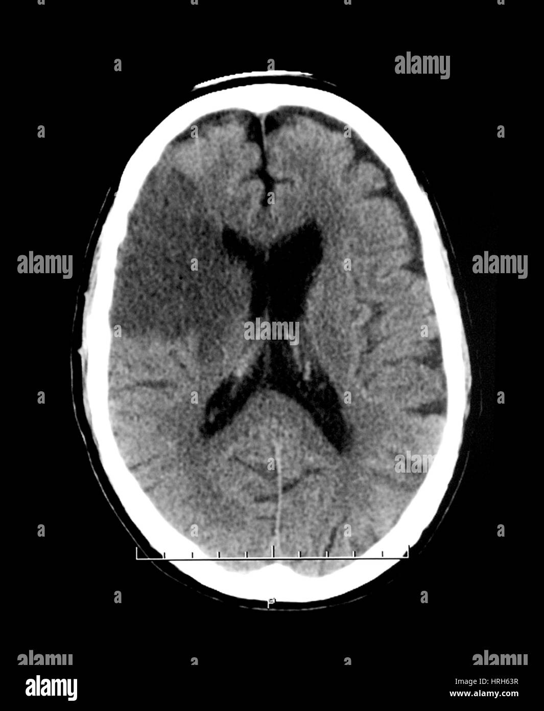 Ct infarto cerebral fotografías e imágenes de alta resolución - Alamy