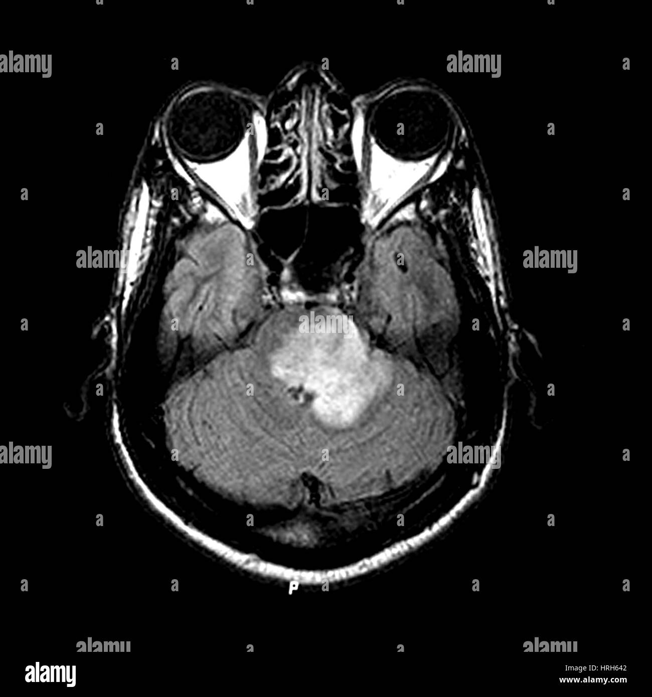 MRI de la esclerosis múltiple aguda Foto de stock