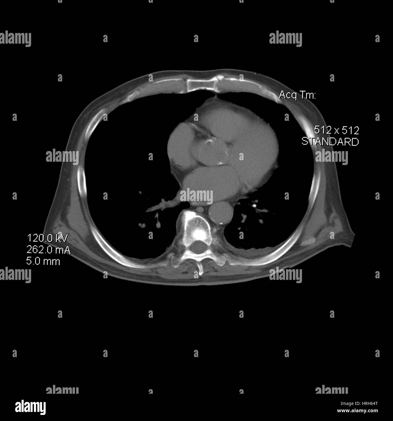 El cáncer de próstata CT Foto de stock