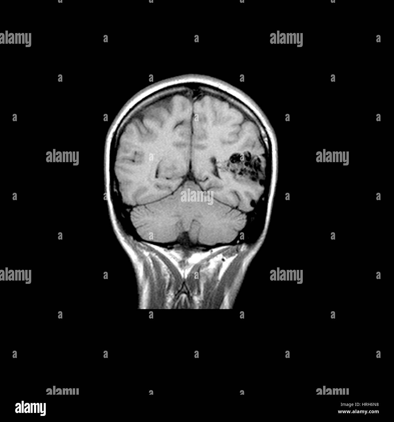 Irm del cerebro AVM Foto de stock