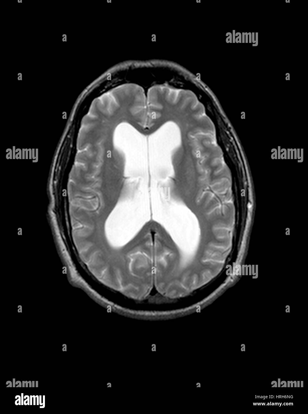 MRI Hidrocefalia comunicante (NPH) Foto de stock