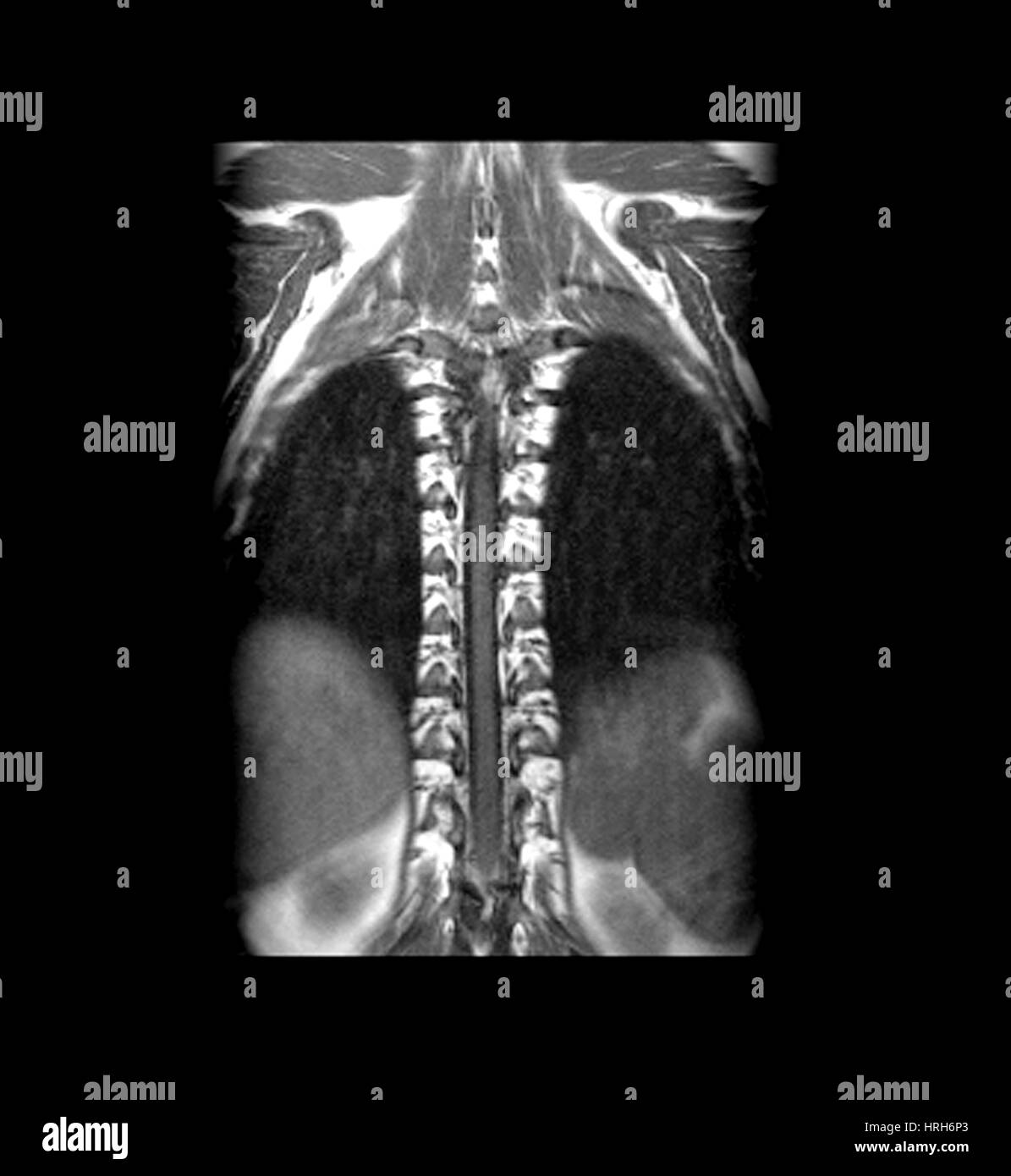 Irm normal de la columna torácica Foto de stock