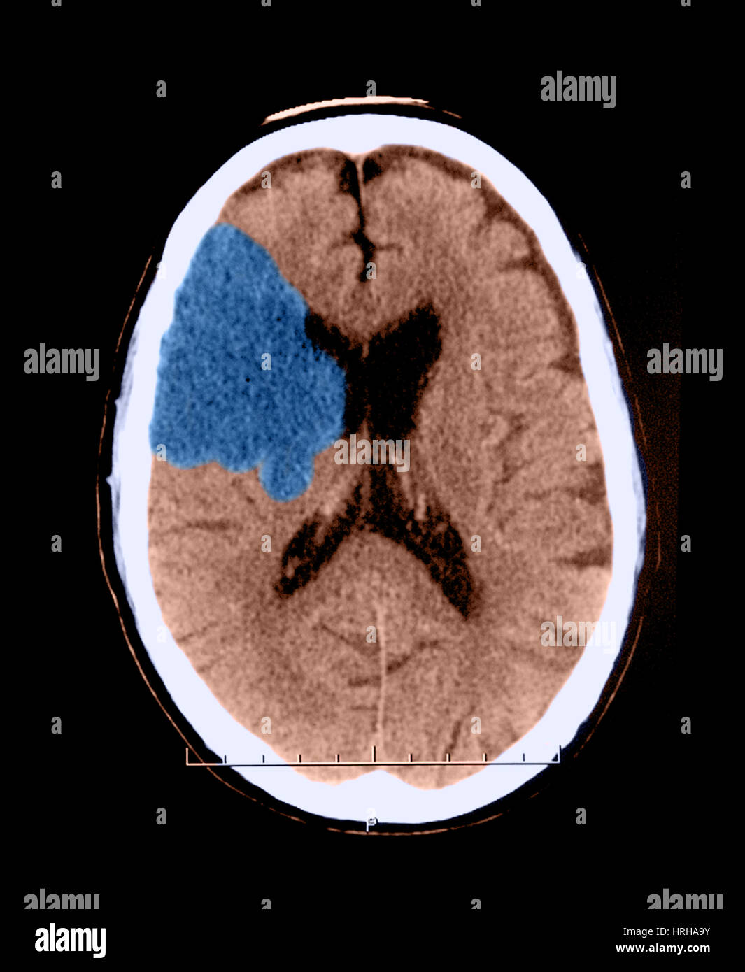 CT de accidente cerebrovascular Foto de stock