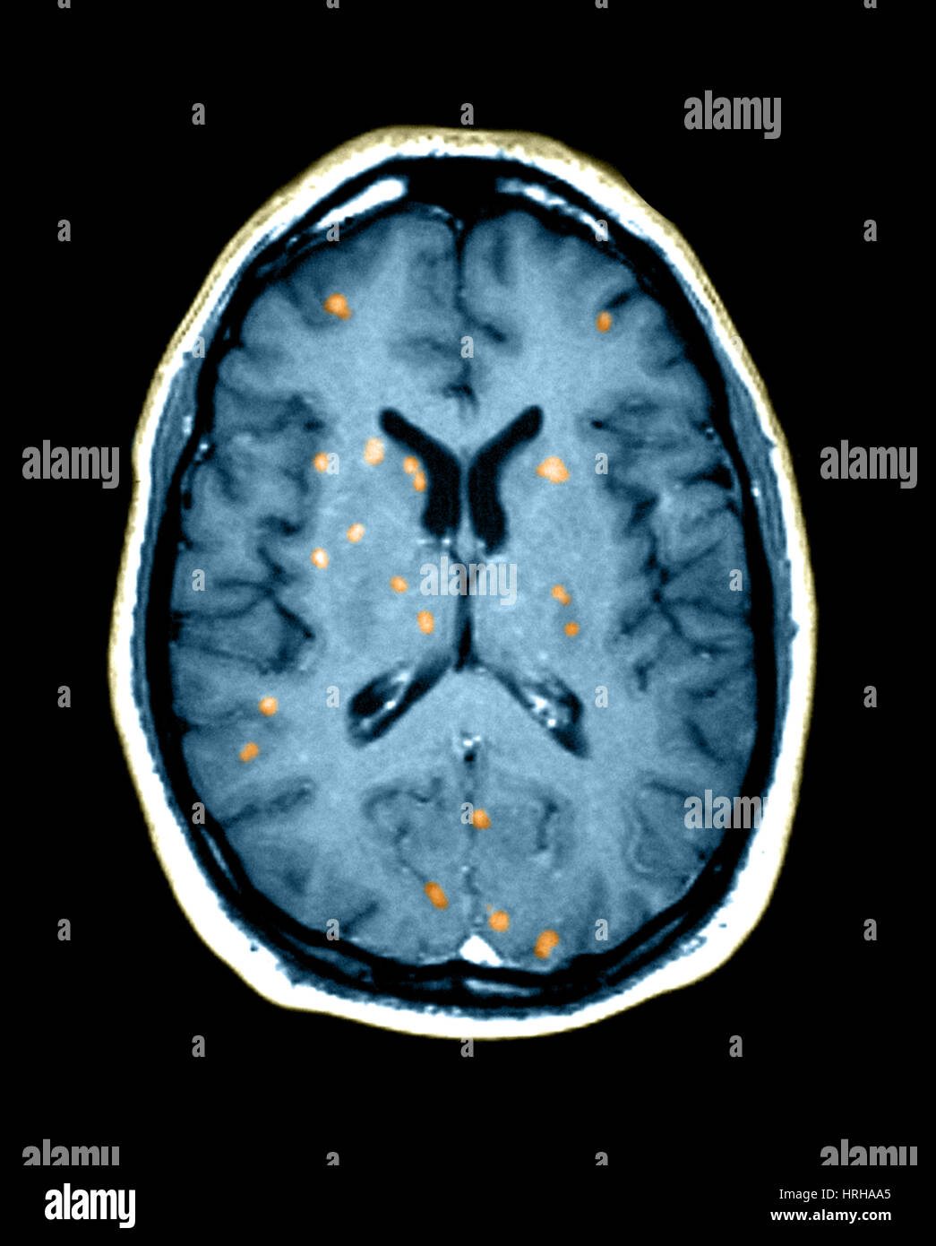 Rm anormal del cerebro Foto de stock