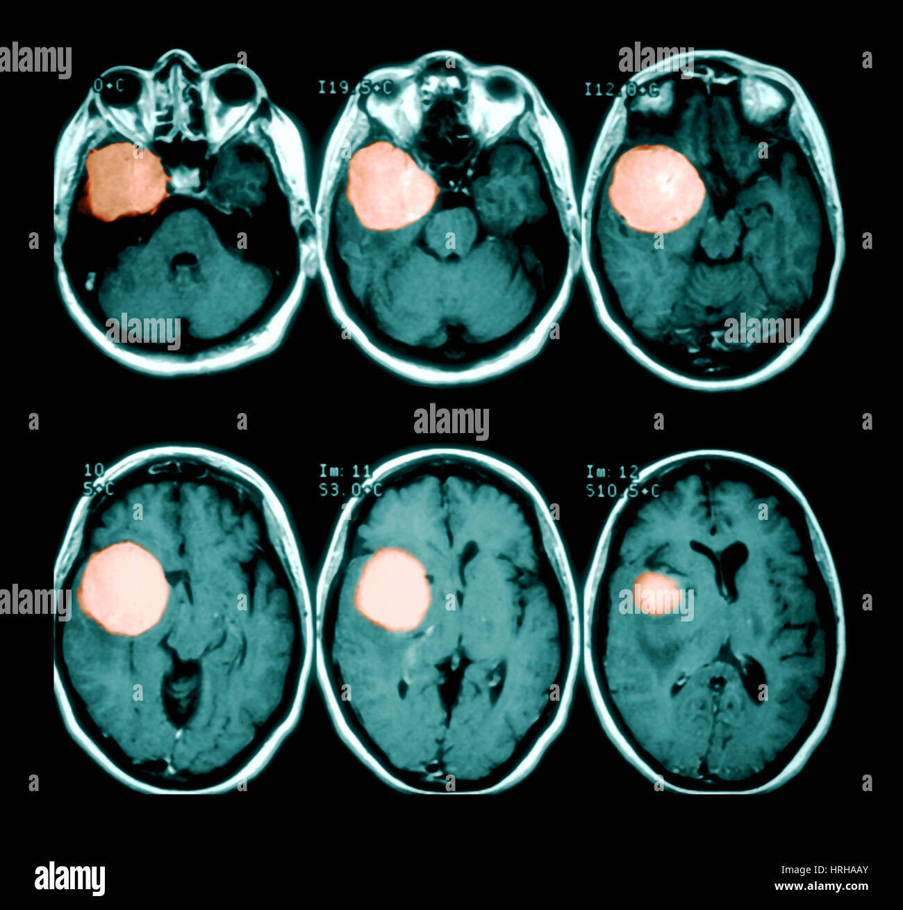 Tumor cerebral Foto de stock