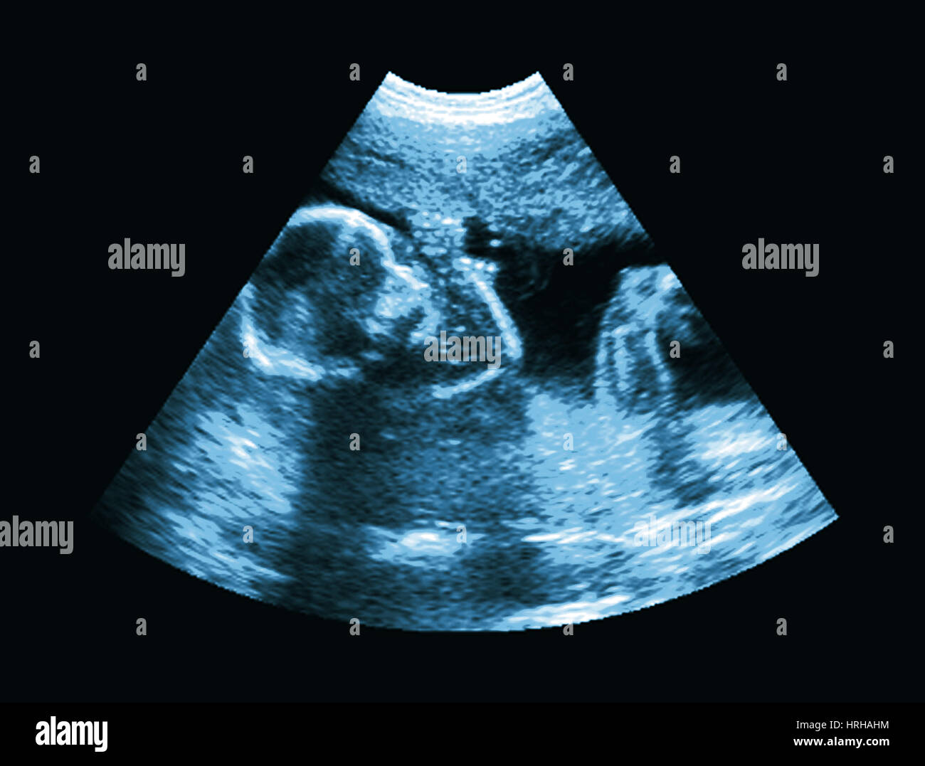 Ultrasonido del feto Foto de stock