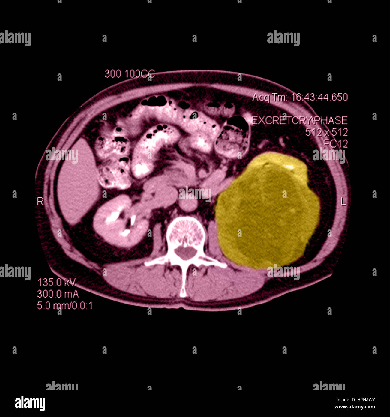 Tac de abdomen, Grandes Carcinoma Renal Foto de stock