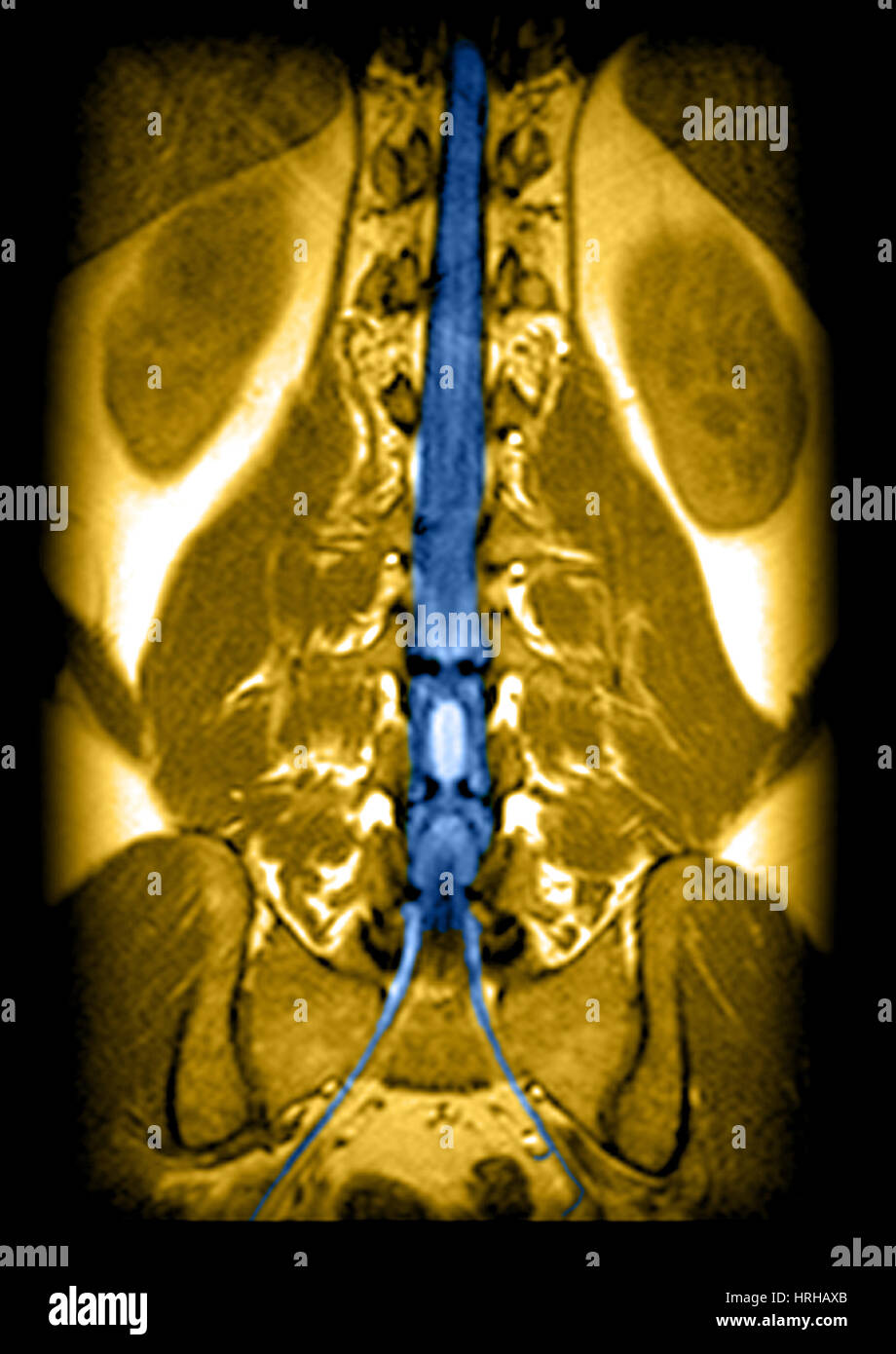 Irm de la médula espinal y las raíces nerviosas Foto de stock