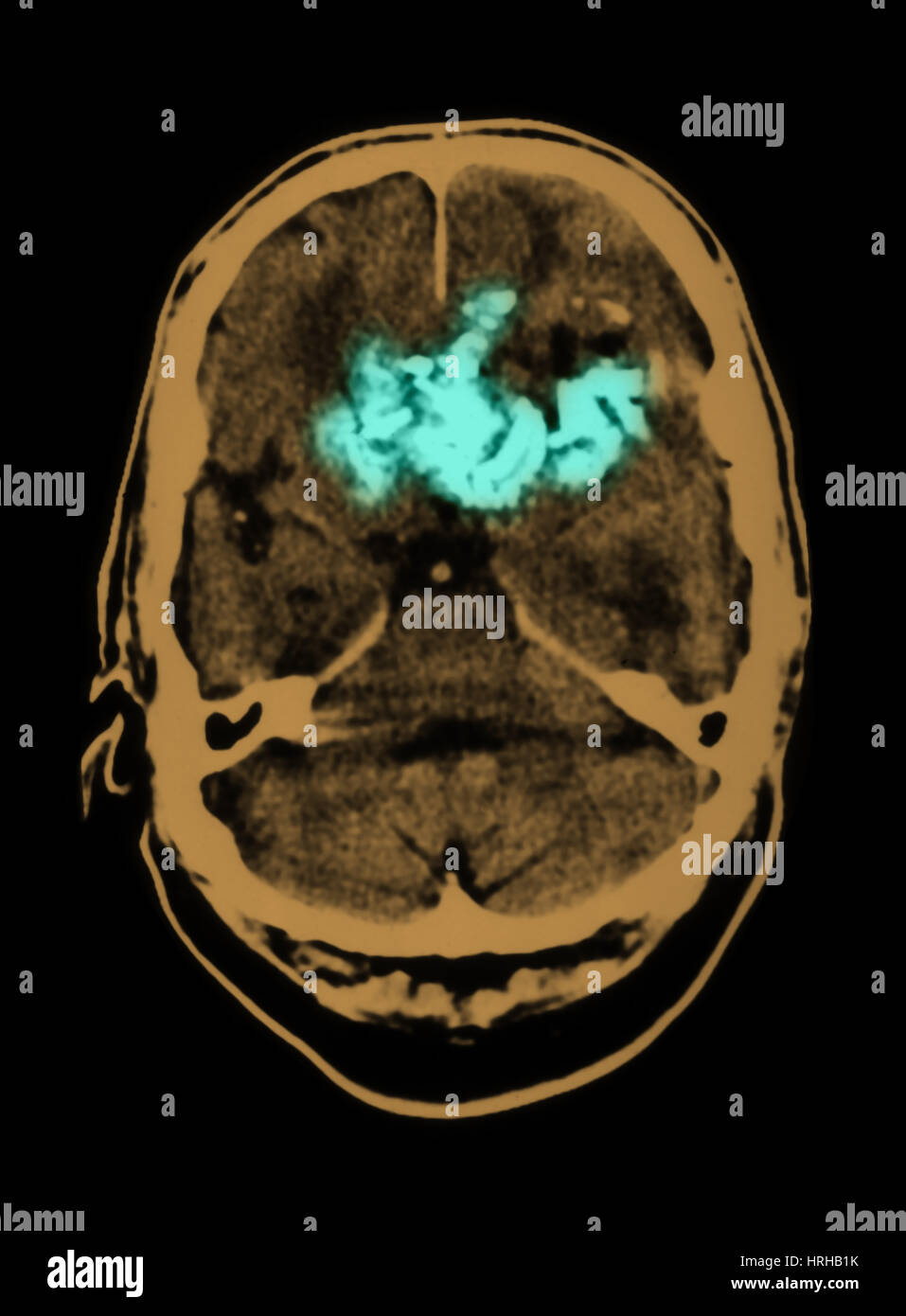 El oligodendroglioma Foto de stock