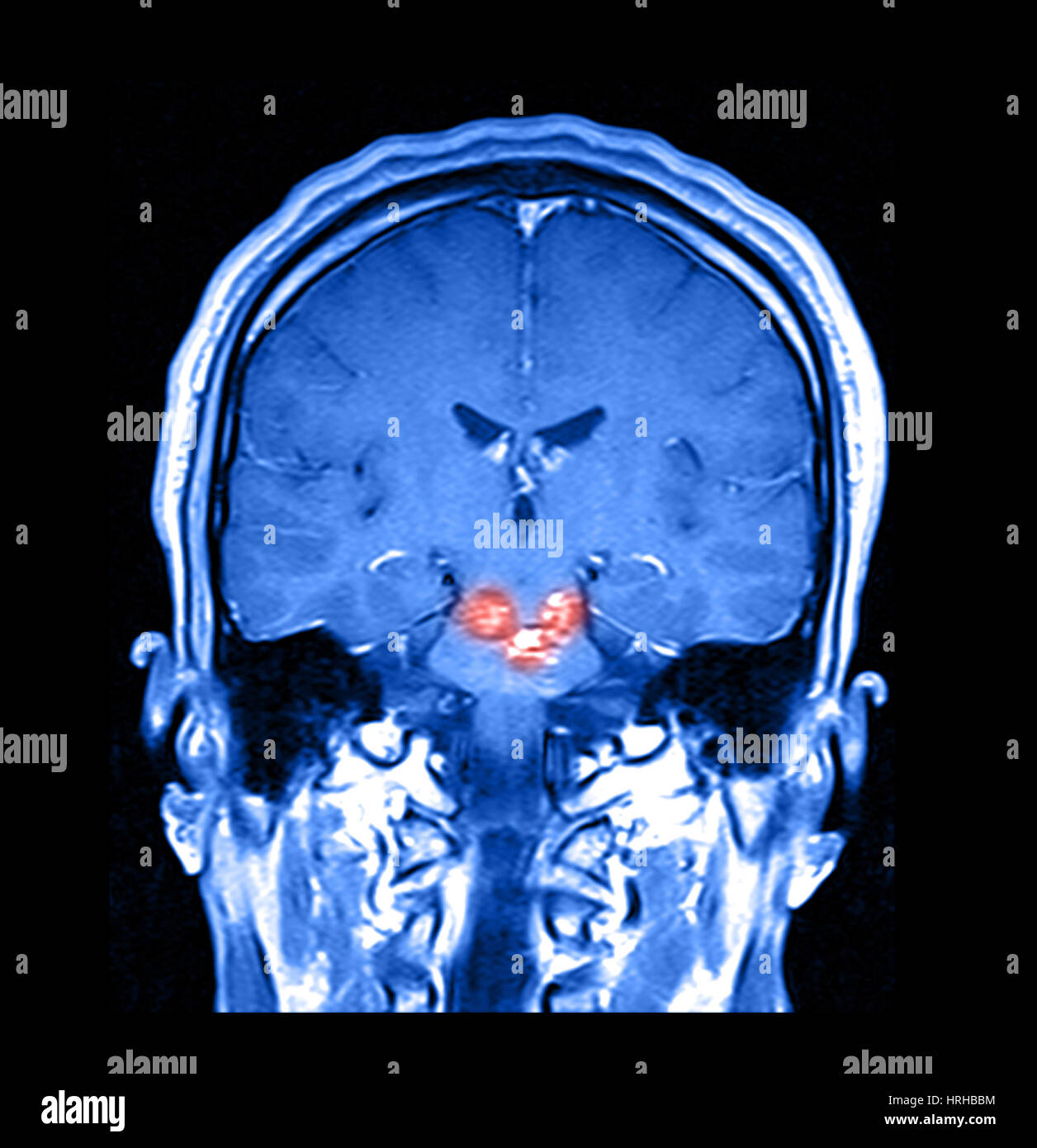 MRI malformaciones cavernoso del tallo cerebral Foto de stock