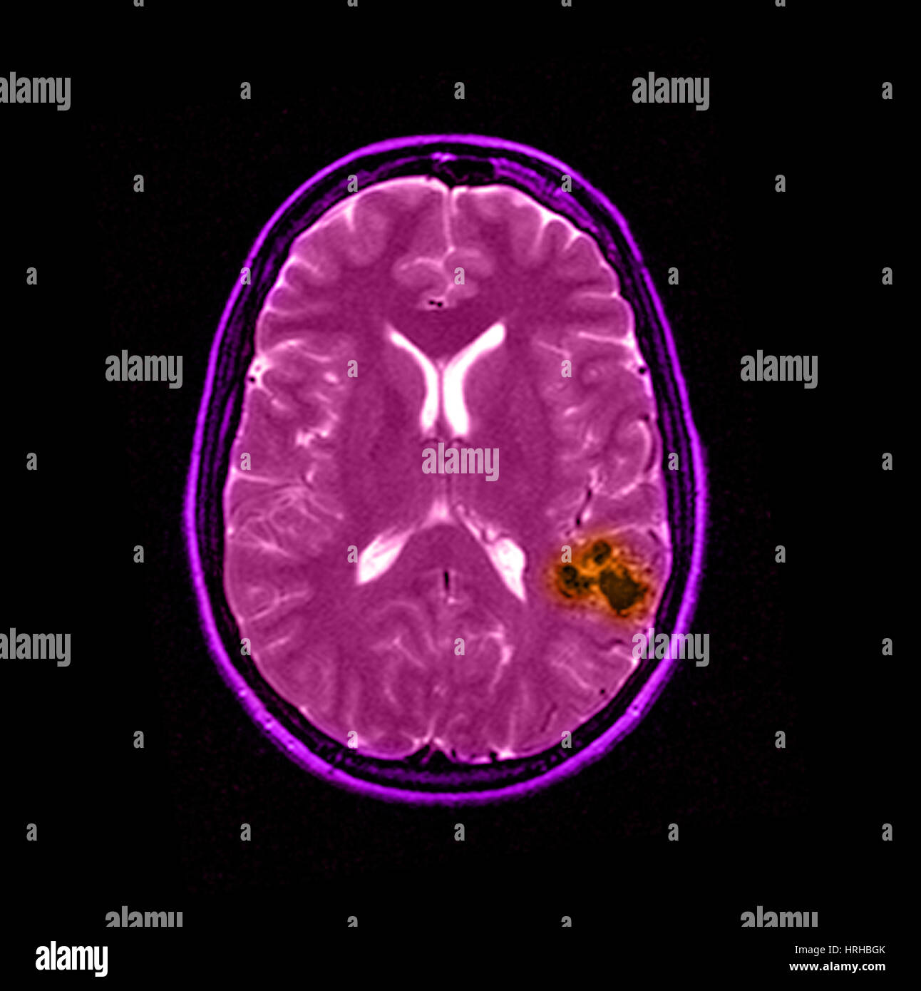 Irm Del Cerebro AVM Fotograf a De Stock Alamy