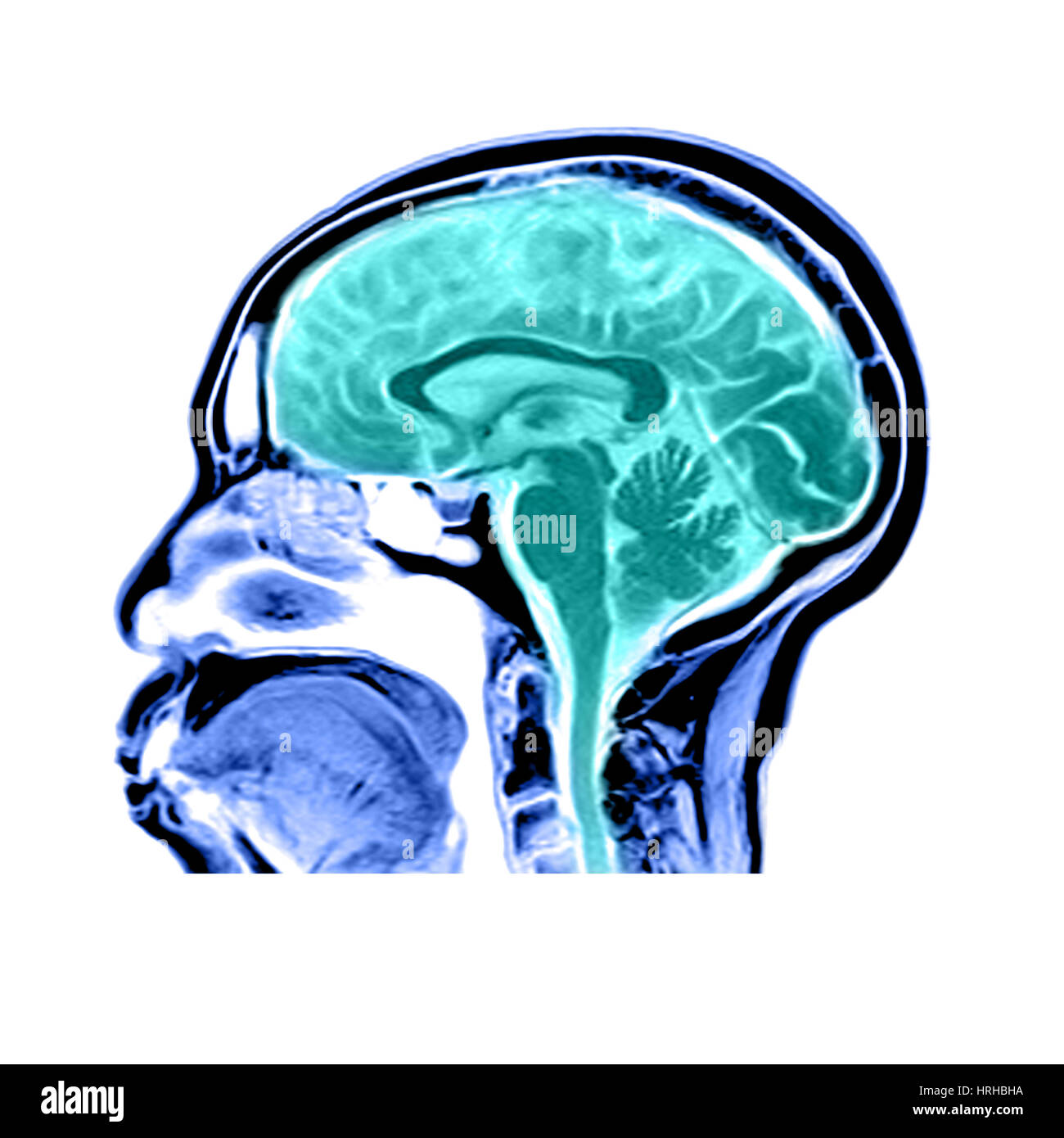 Vista sagital de una resonancia magnética del cerebro Foto de stock