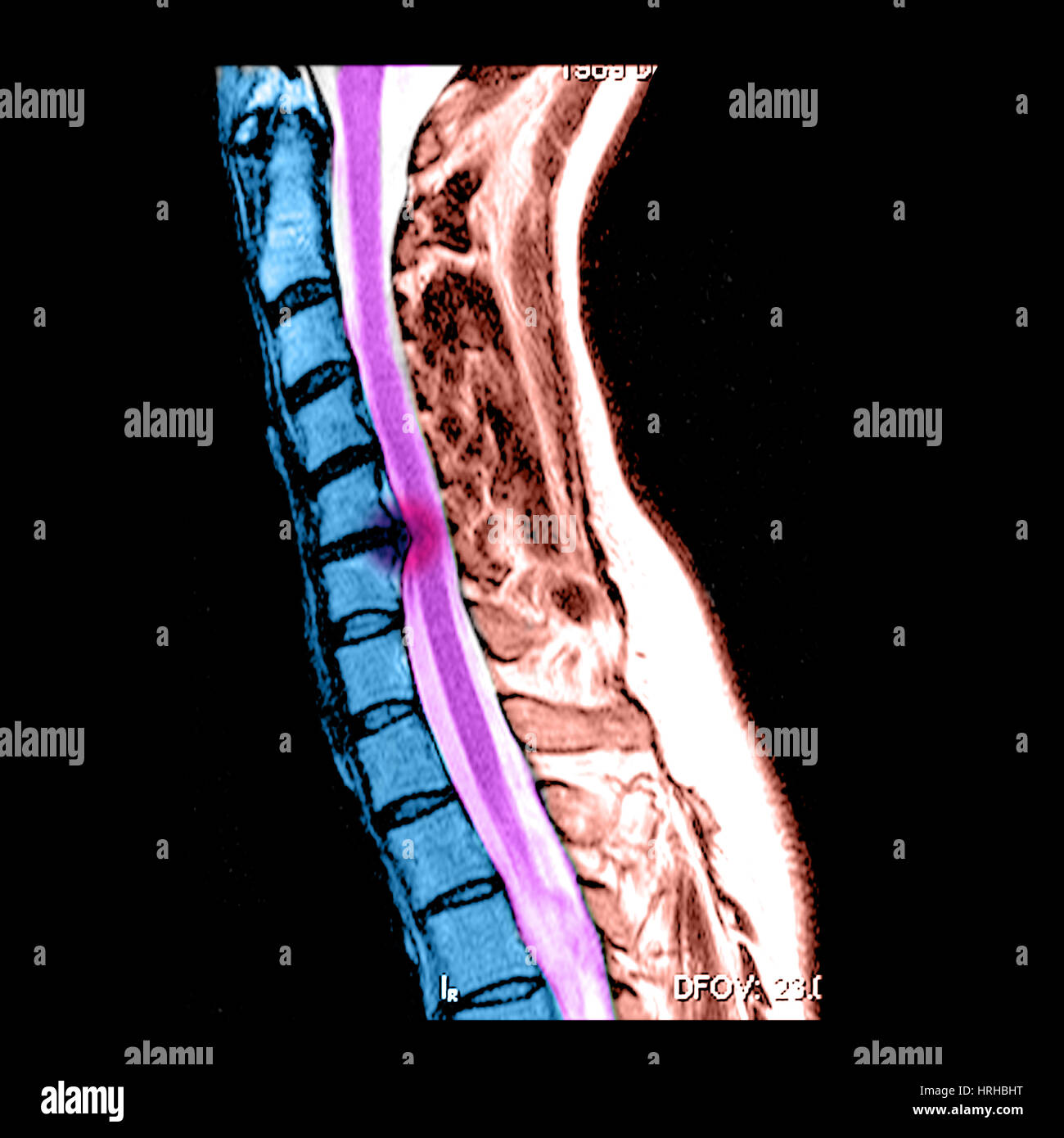 Hernia de disco en la columna cervical Foto de stock