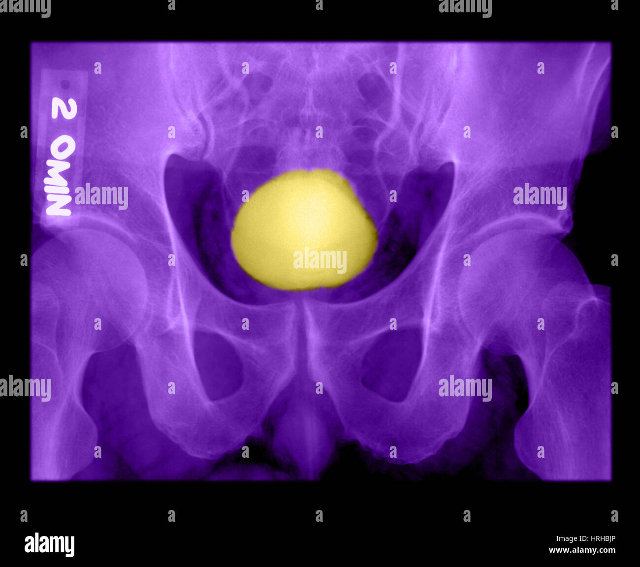 Xray de vejiga urinaria normal Foto de stock