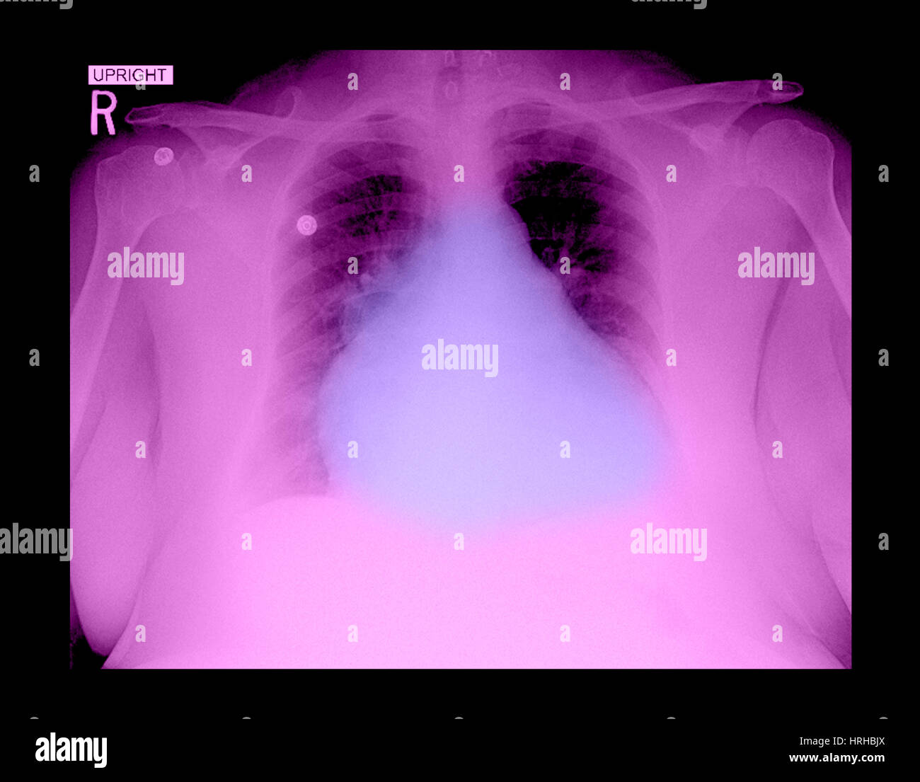 Arriba 105+ Imagen Radiografia De Un Corazon De Origami Lleno