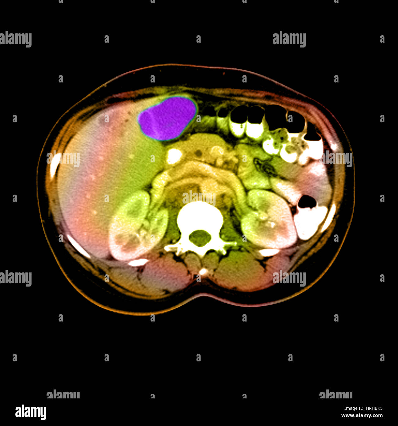 Tomografía computarizada de un tumor hepático Foto de stock