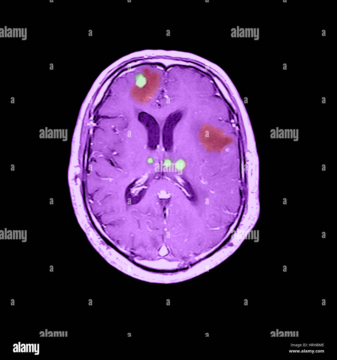 Tumores cerebrales Foto de stock