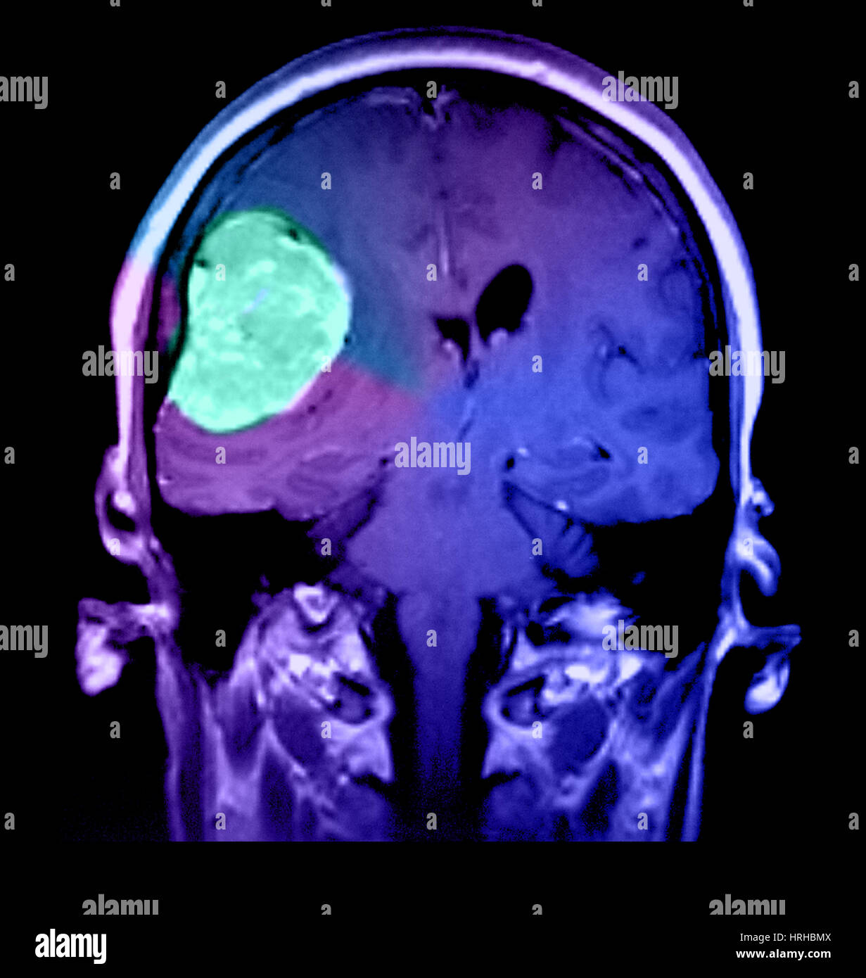 Meningioma del lado derecho Foto de stock