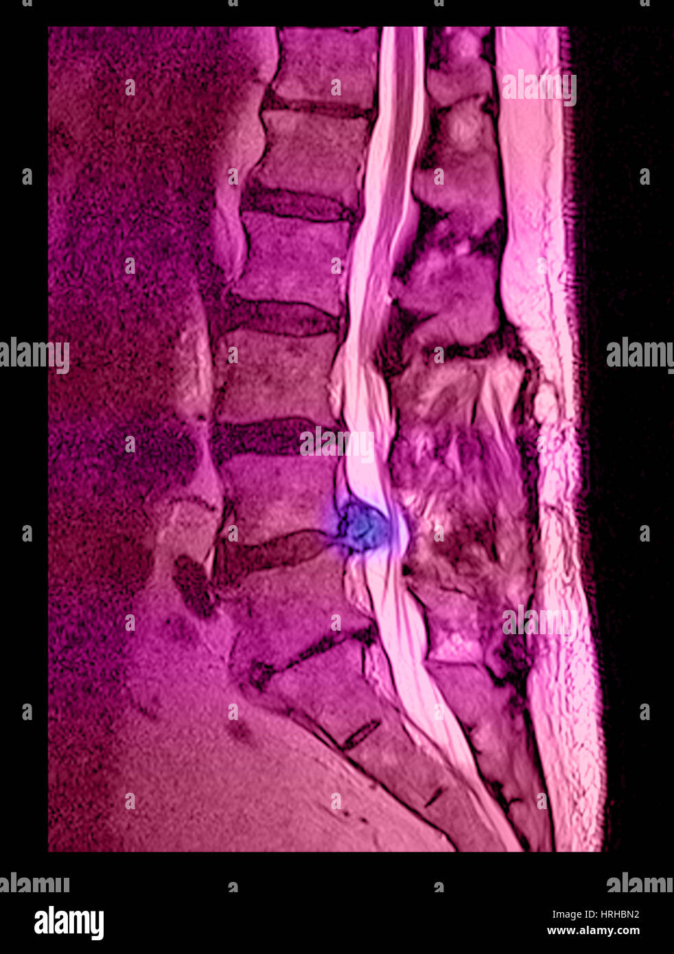 Hernia de disco Foto de stock