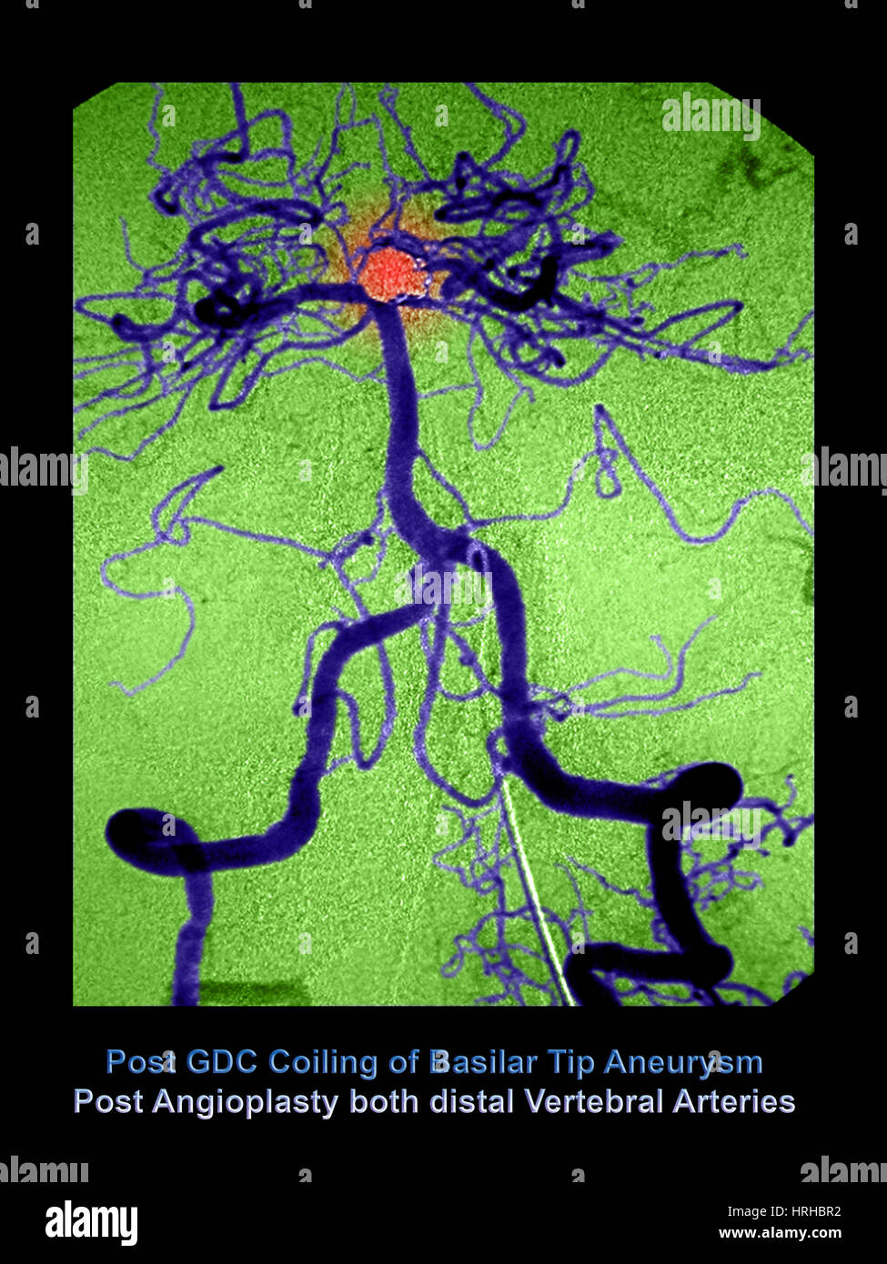 Angiograma cerebral Foto de stock