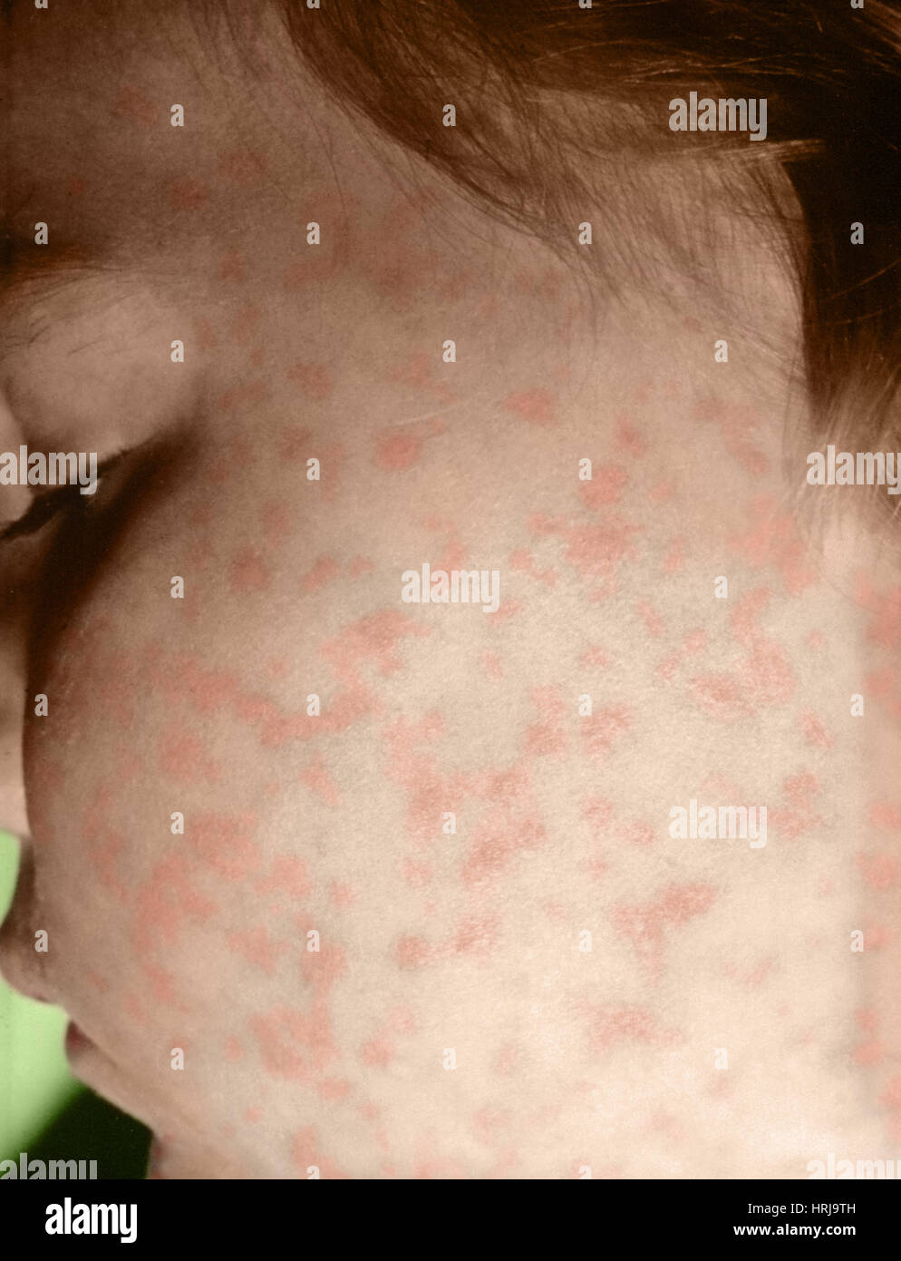 La fiebre maculosa de las Montañas Rocosas Fotografía de stock Alamy