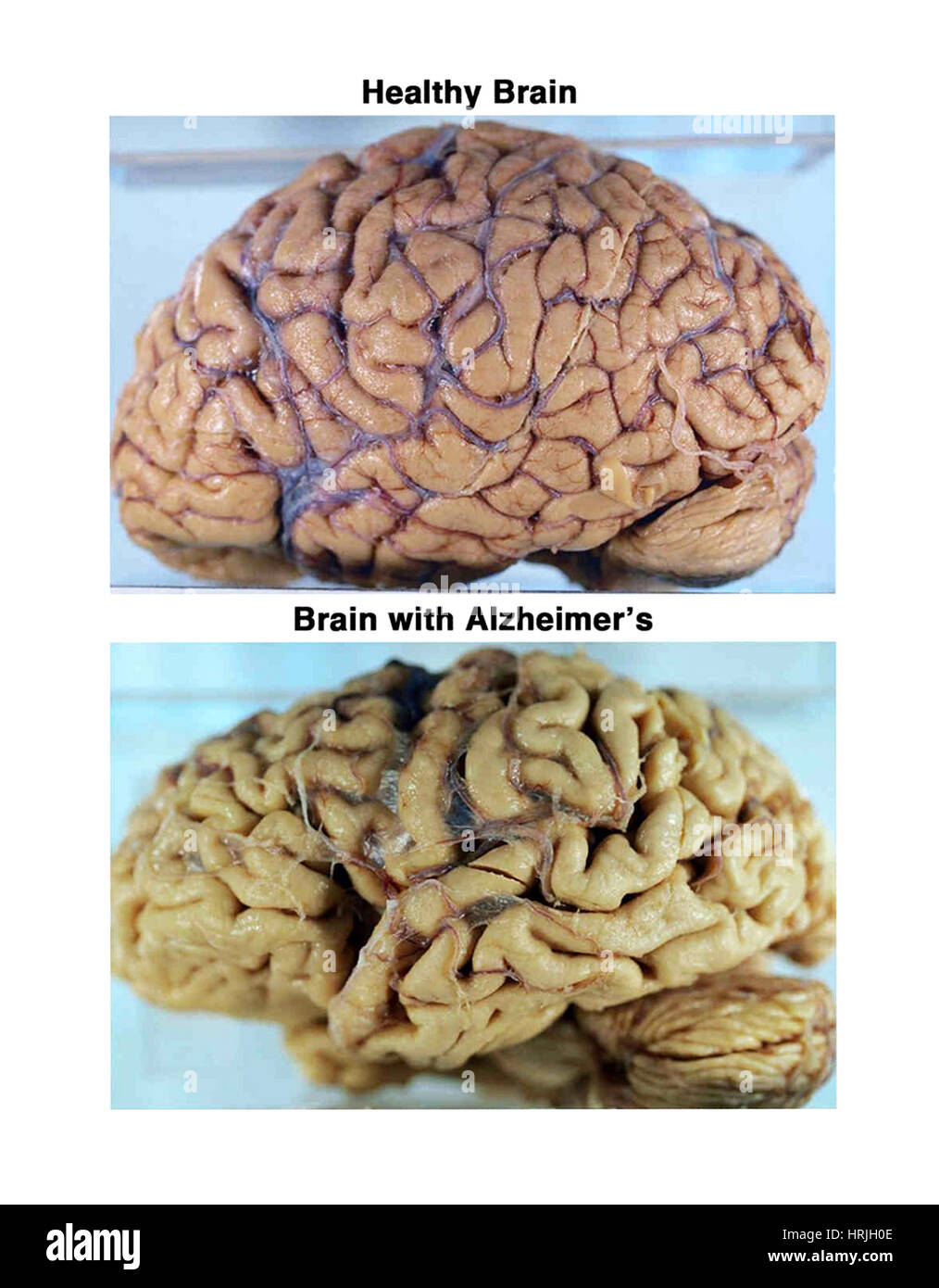 Y Alzheimer cerebros sanos, especímenes bruto Foto de stock