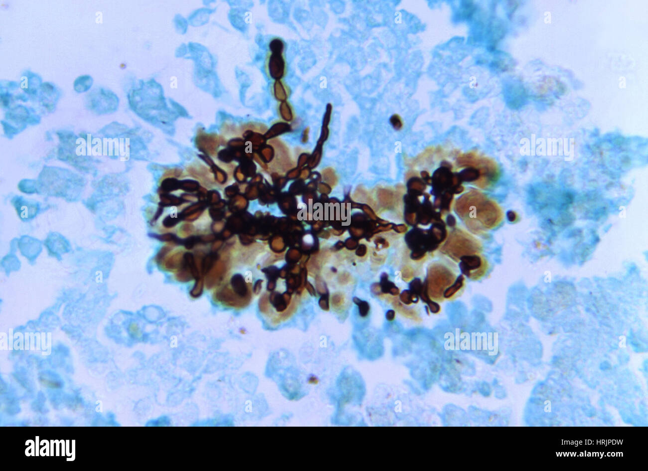 Candida albicans, infección micótica LM Foto de stock