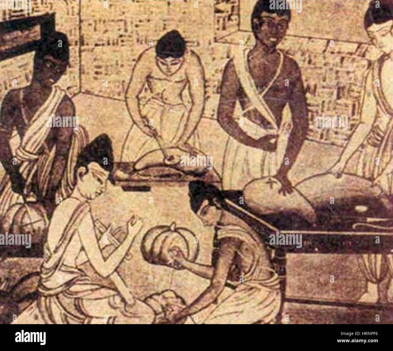 Saushrutas, practicar cirugía, 800 A.C. Foto de stock
