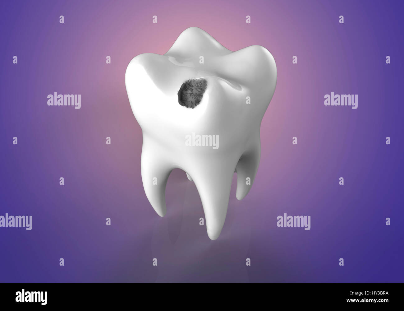 La caries dental. Equipo ilustración de un diente con caries. Foto de stock