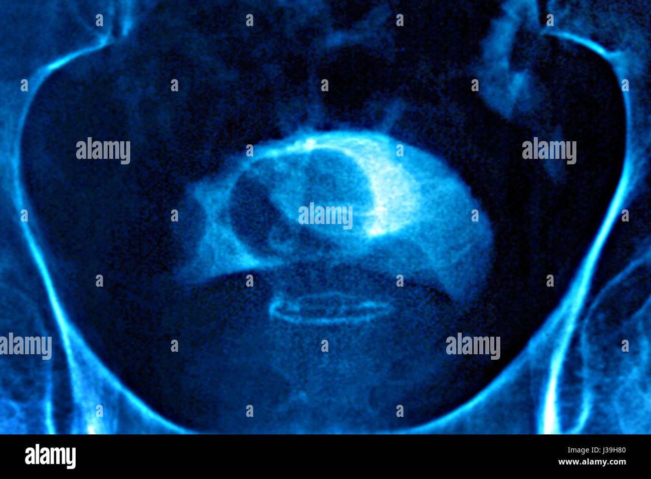 ADENOMA prostático, rayos X Foto de stock