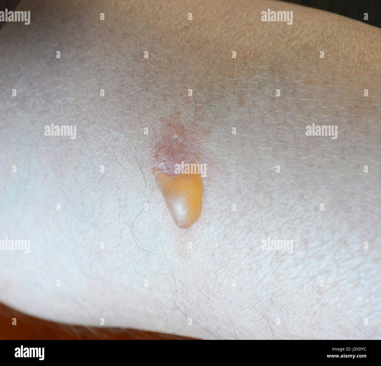 Leech mordedura infectada en una pierna Foto de stock