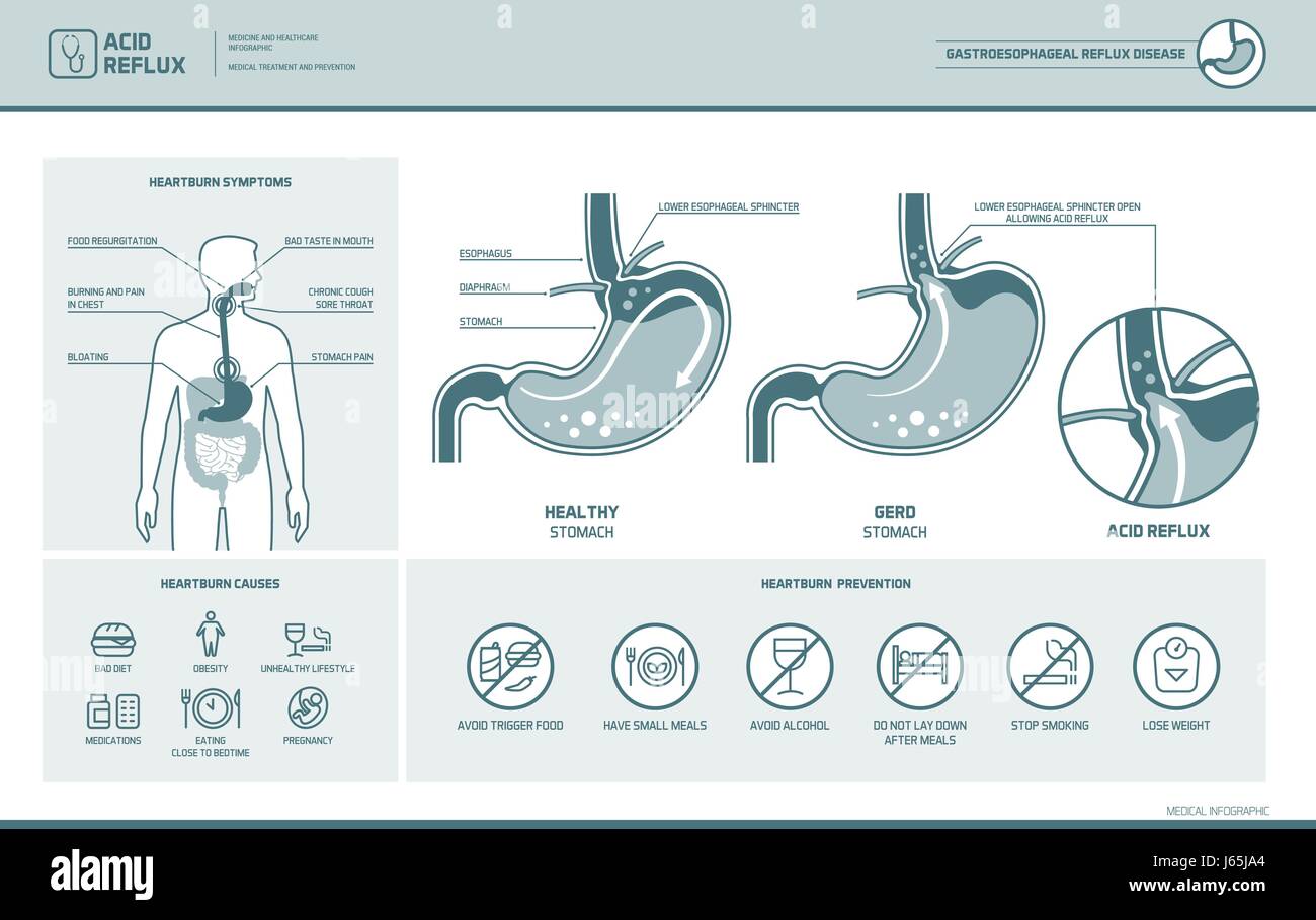 La enfermedad de reflujo ácido, acidez estomacal y Gerd infográfico con estómago ilustración médica, síntomas, causas y prevención Ilustración del Vector