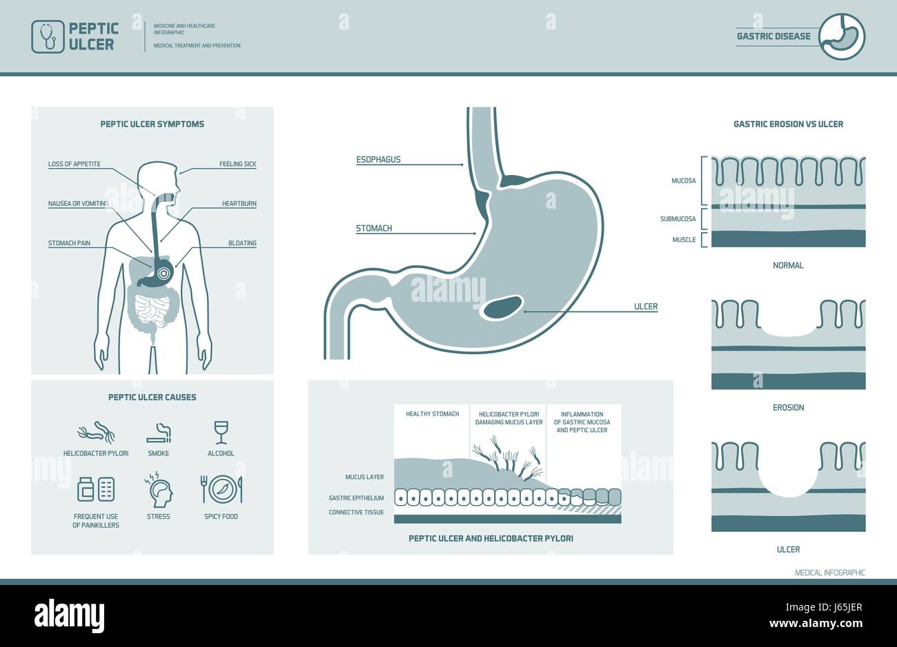 Úlcera péptica y Helicobacter pylori infográfico con síntomas y causas estómago diagrama de sección transversal, ilustración médica Ilustración del Vector