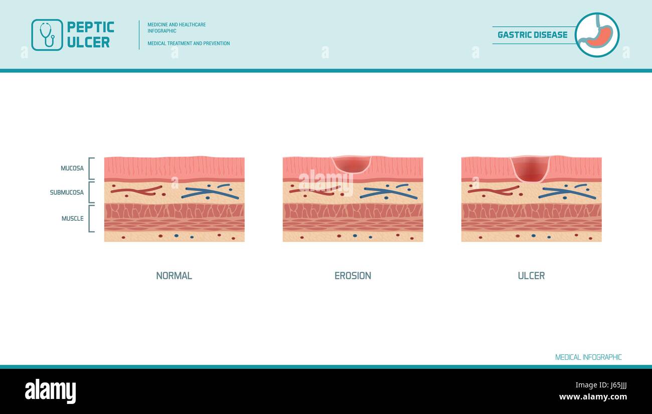 Erosión y úlcera de estómago etapas infografía: el revestimiento del estómago y la mucosa diagrama de sección transversal, ilustración médica Ilustración del Vector