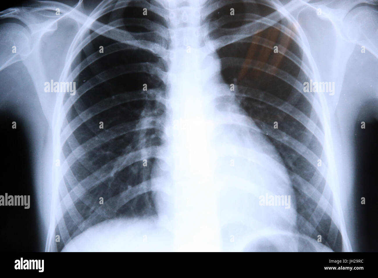 Radiografía de los pulmones. Los rayos x. Ho Chi Minh City. Vietnam. Foto de stock