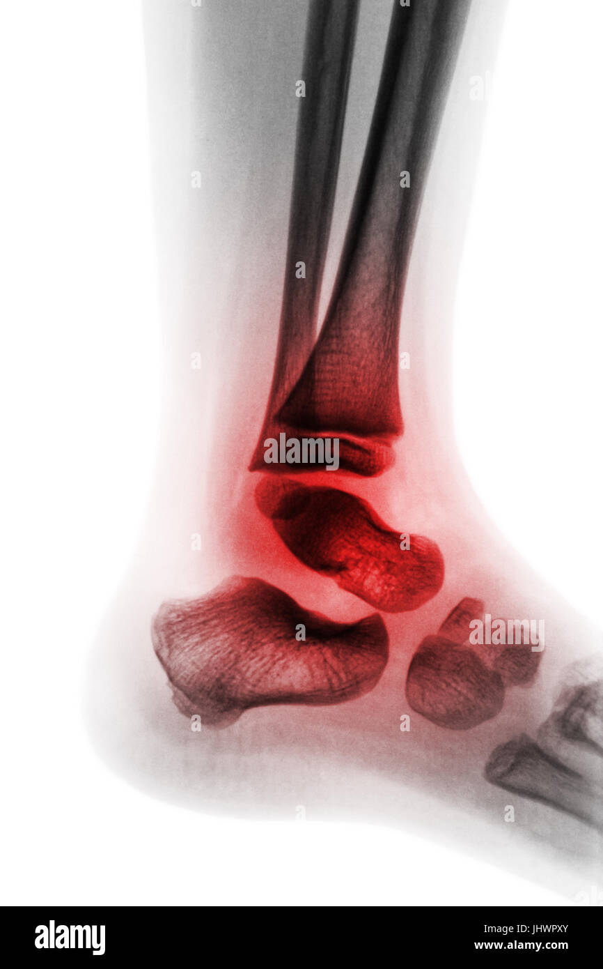 La artritis de tobillo . Radiografía de tobillo infantil e inflamar abatible . Vista lateral . ( Concepto de artritis reumatoidea juvenil ) Foto de stock