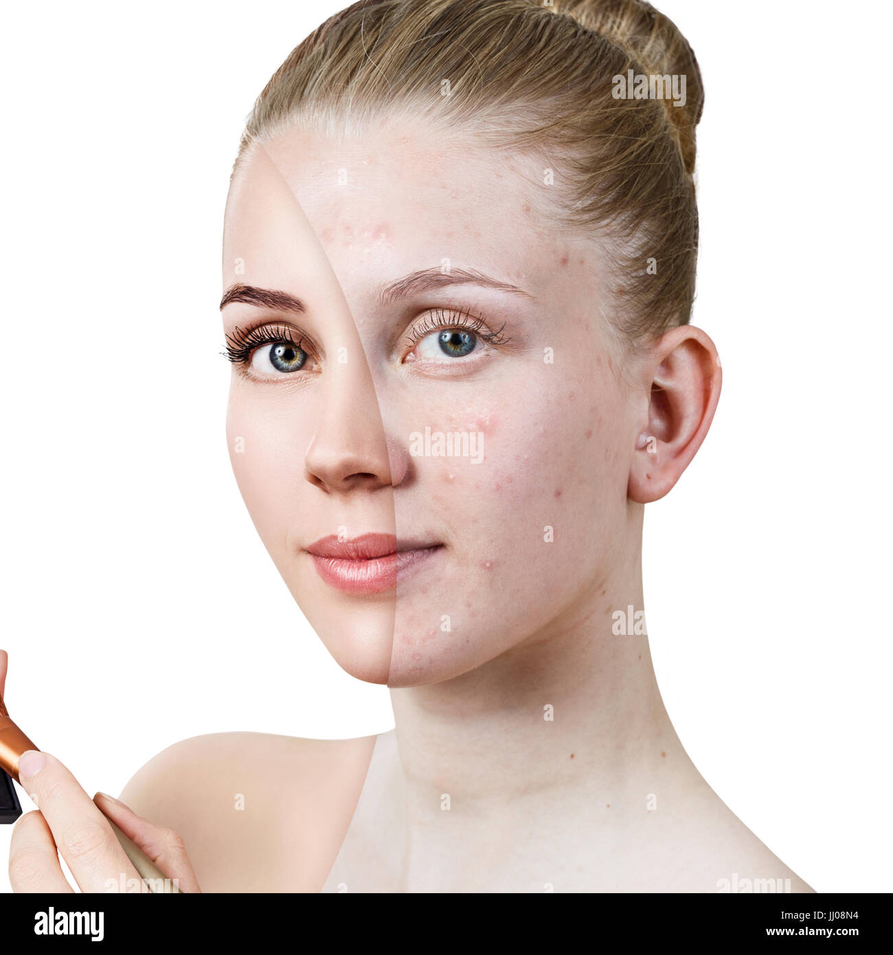 Mujer joven con acné antes y después del tratamiento. Foto de stock