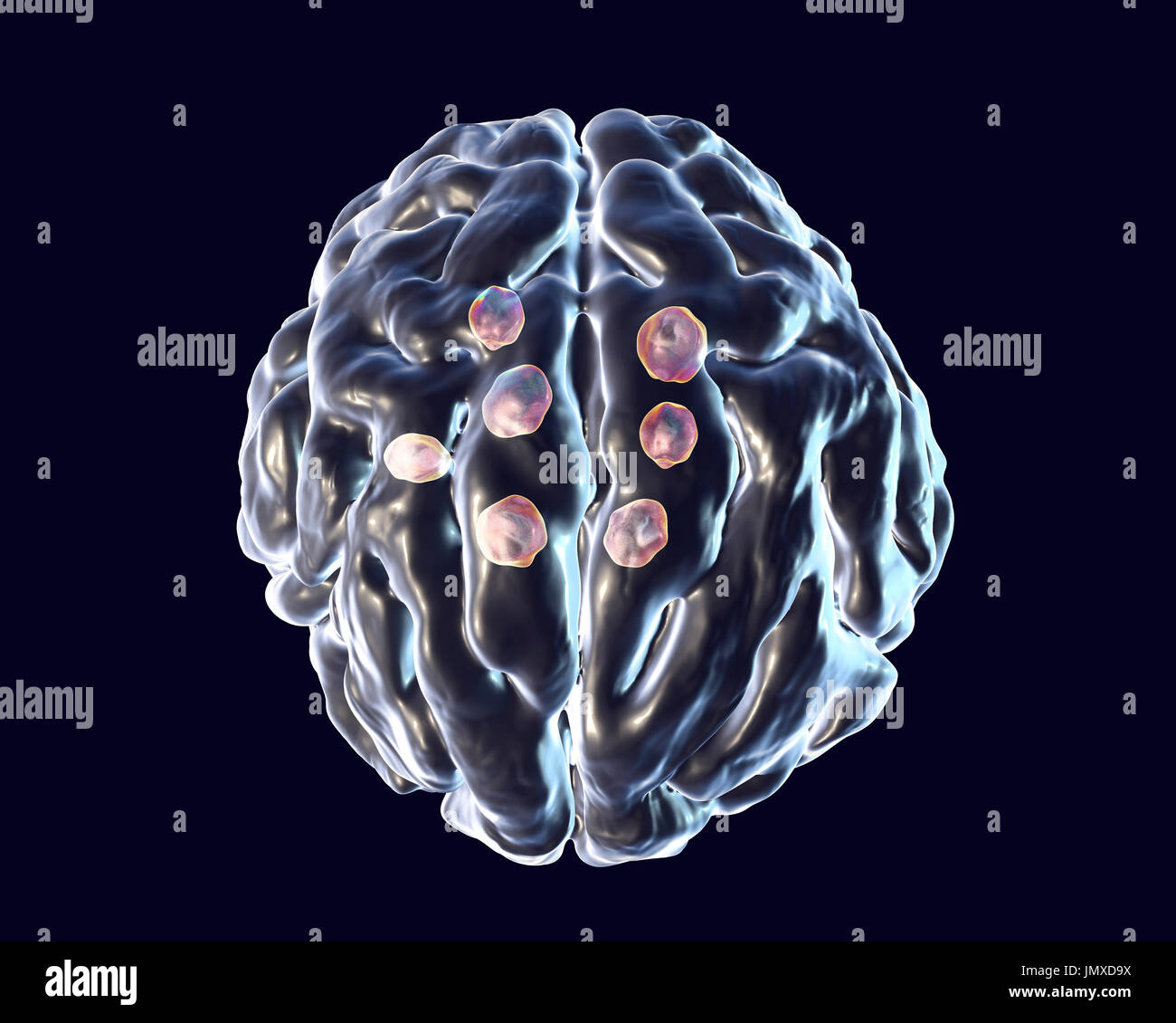 Las lesiones cerebrales criptococos. Ilustración de múltiples lesiones de parénquima cerebral
