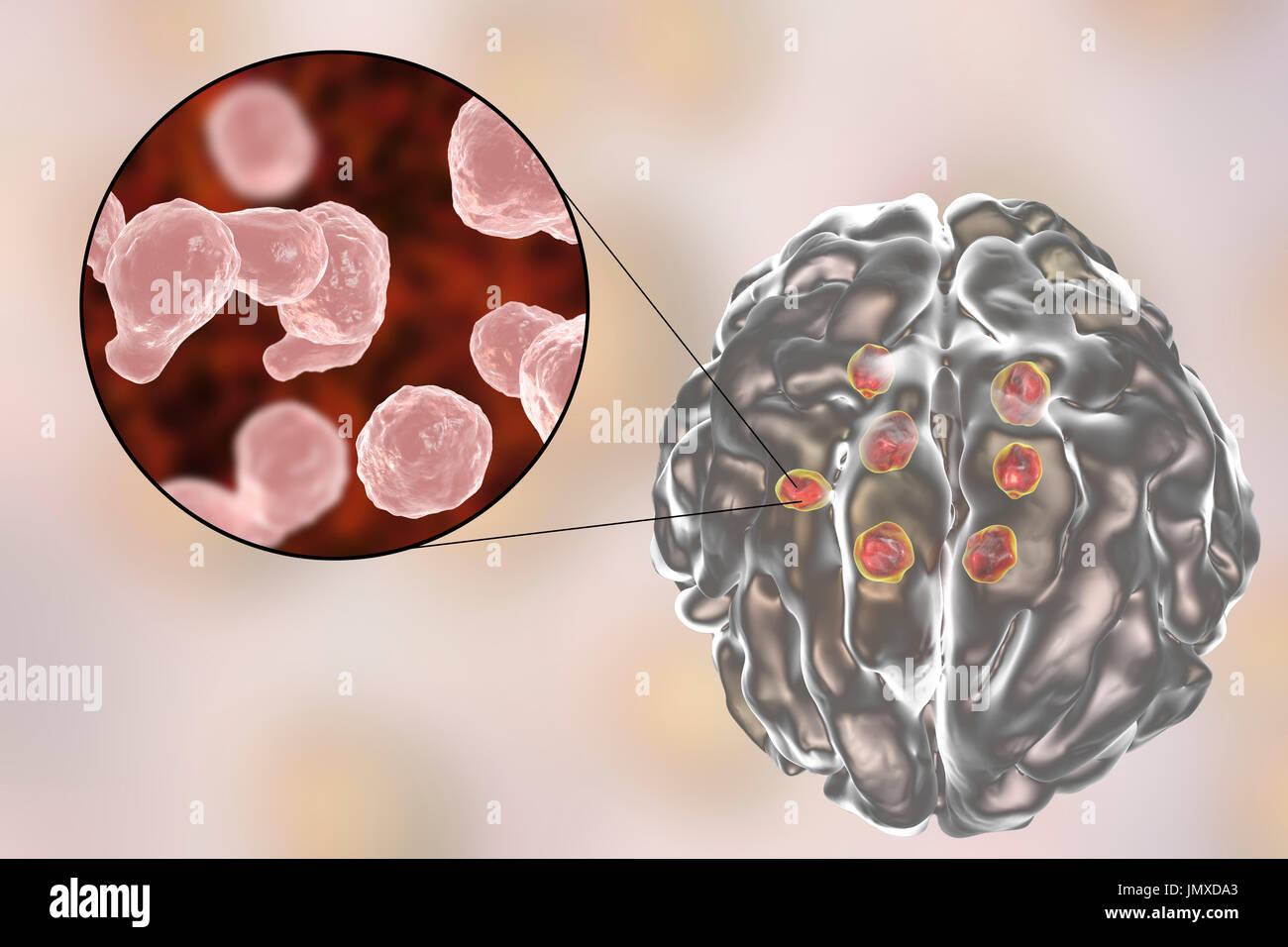 Las lesiones cerebrales criptococos. Ilustración de múltiples lesiones de parénquima cerebral