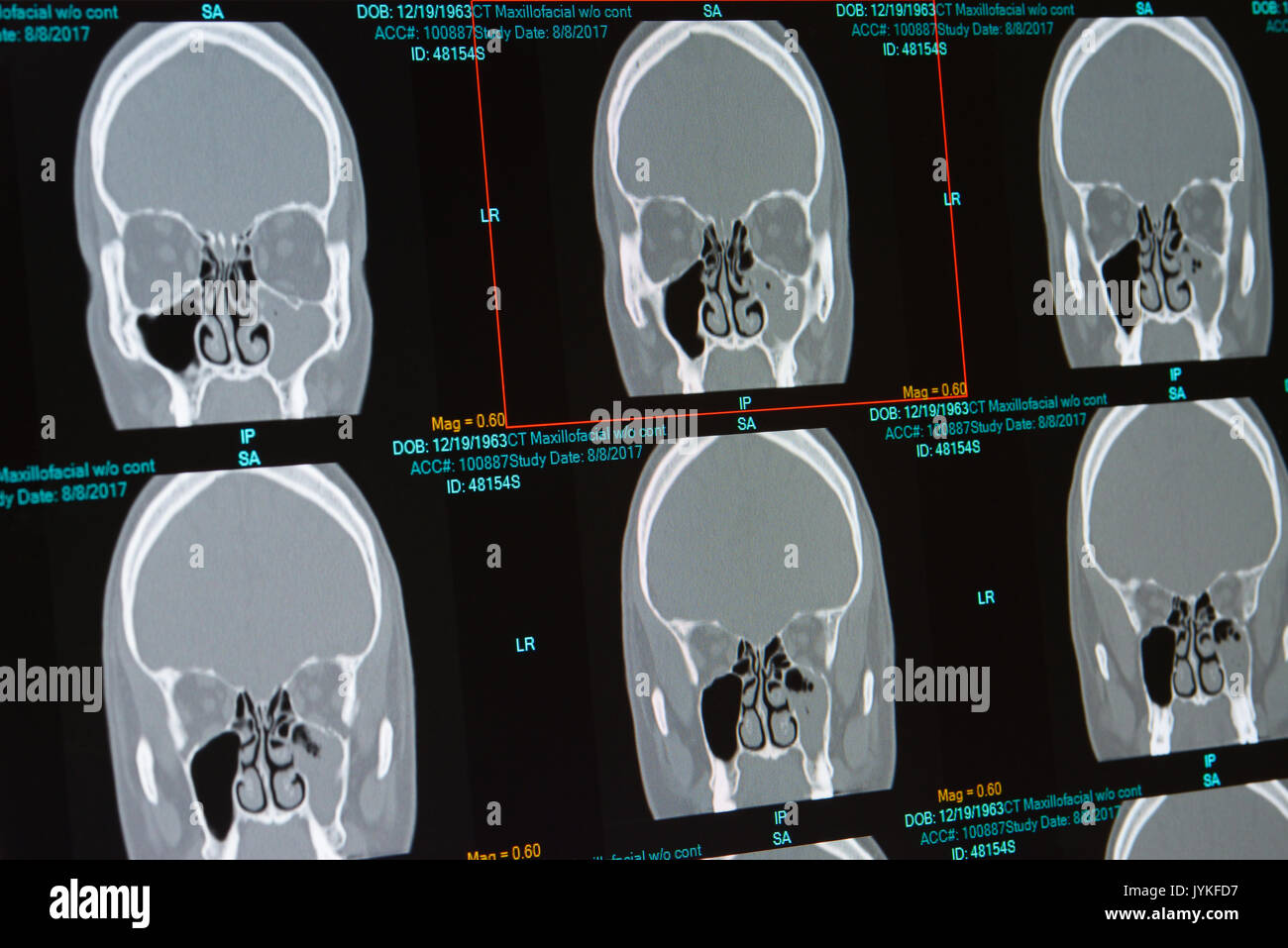 Tomografía computarizada de varones con infección de los senos paranasales (sinusitis) Llenado del seno maxilar izquierdo. También revela tabique desviado Foto de stock