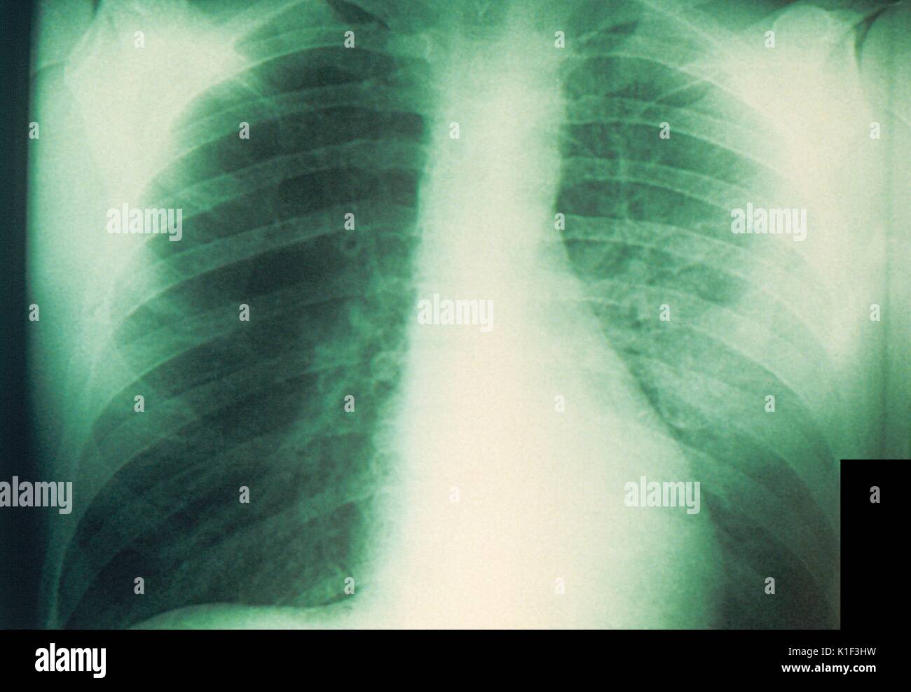 Radiografía de tórax en un paciente con enfermedad de Niemann Pick
