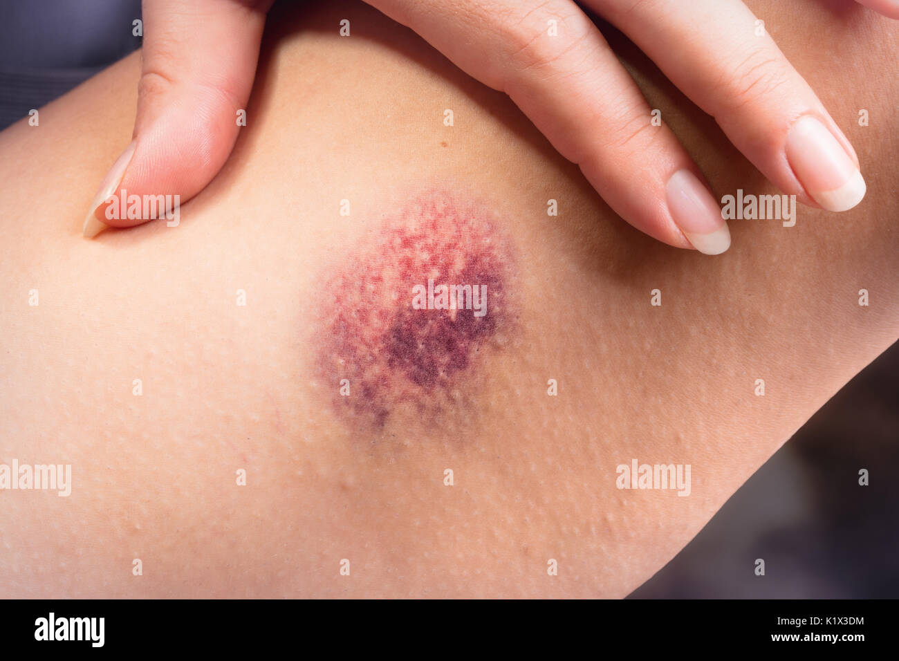 Hematoma en la mujer las piernas - concepto de abuso y violencia Foto de stock