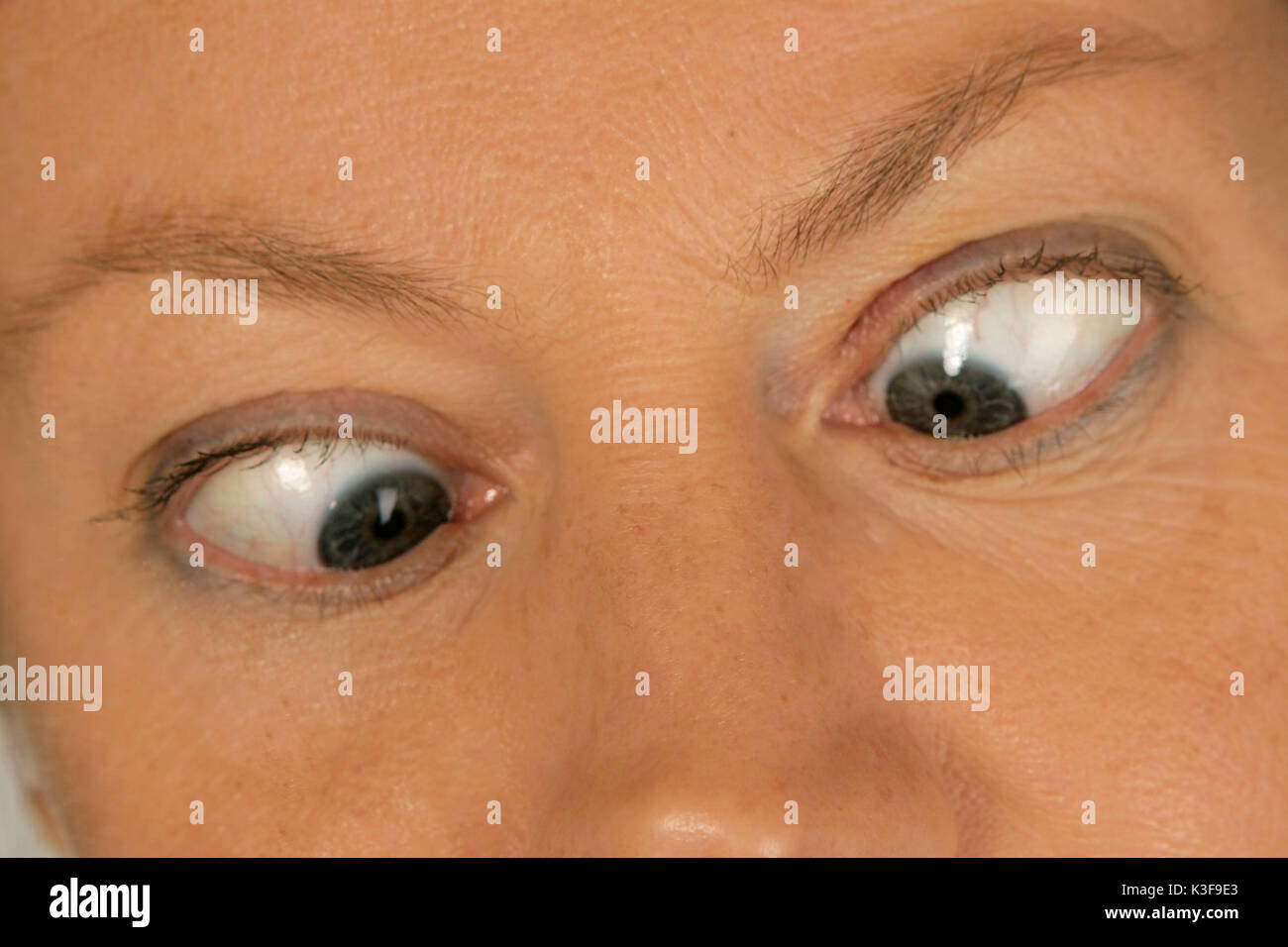 Bizco de ojos bizcos fotografías e imágenes de alta resolución - Alamy