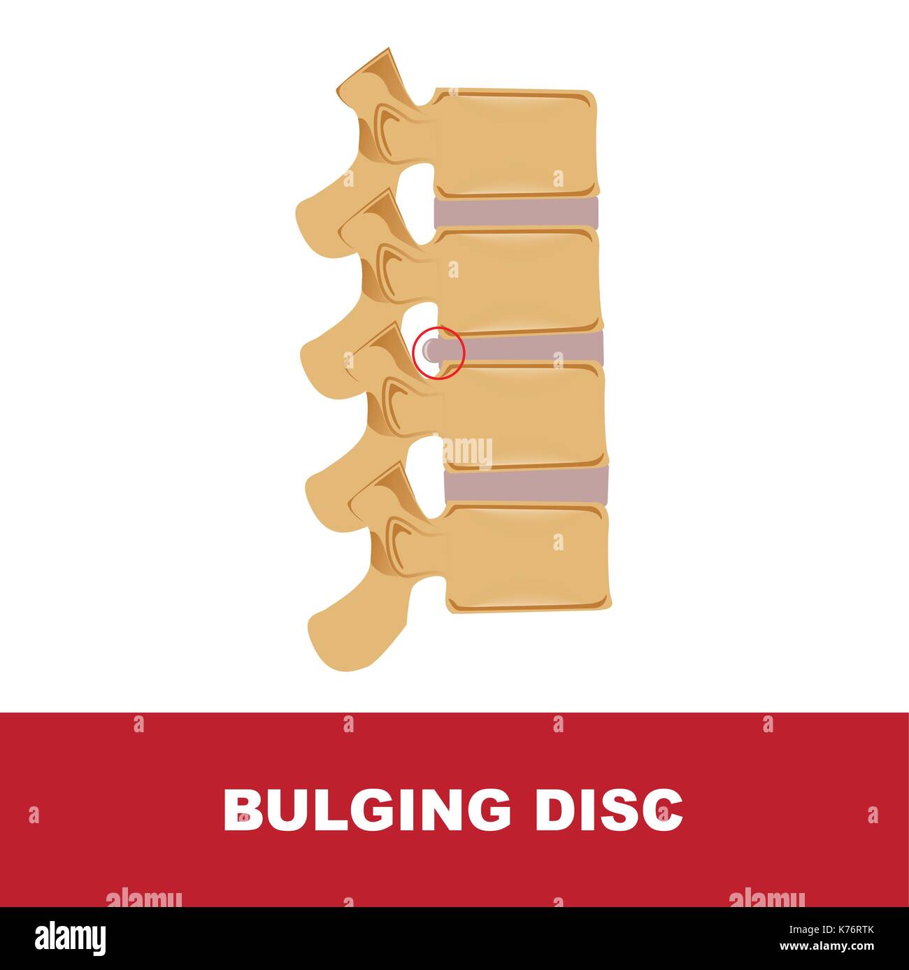 La degeneración del disco disco abultado con degeneración. Ilustración del Vector