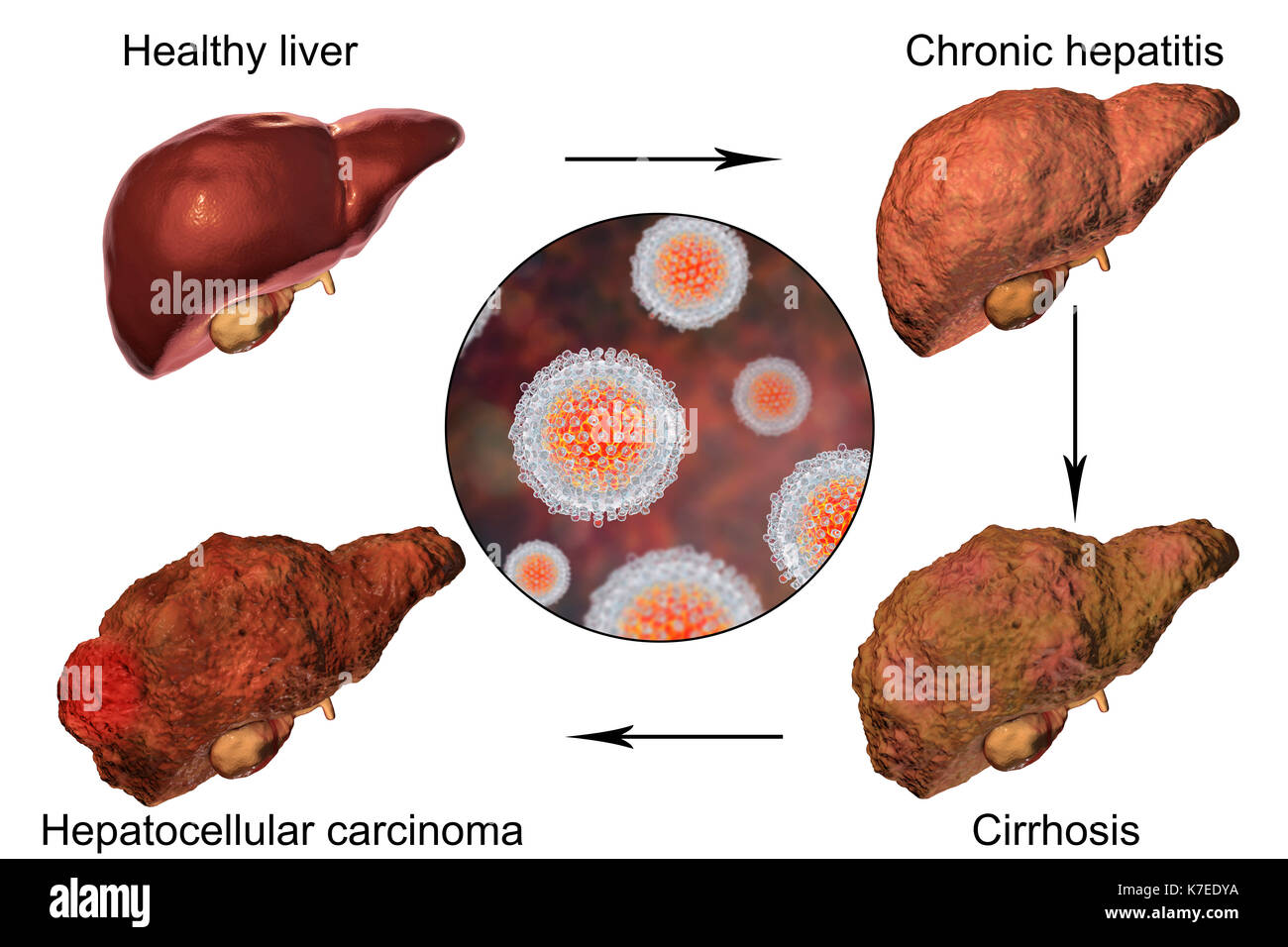 Hígado humano mostrando las etapas de la enfermedad hepática en la hepatitis C una infección