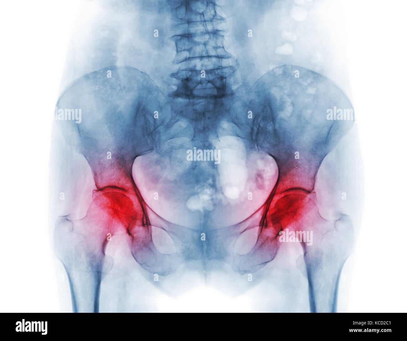 Película de rayos x de la pelvis de la osteoporosis y la artritis del paciente tanto la cadera . Foto de stock