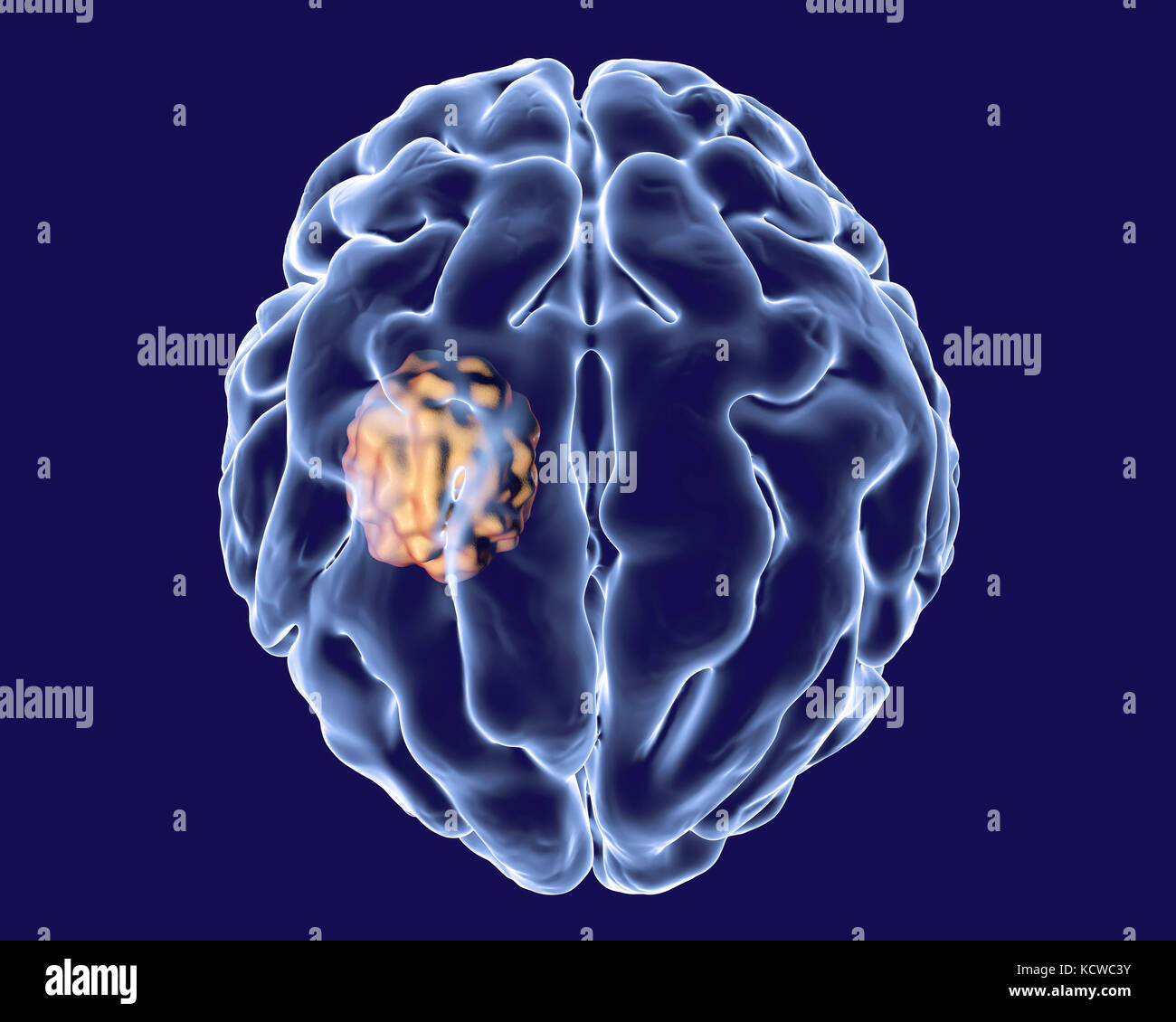 Aspergiloma del cerebro y la vista cercana de hongos del género Aspergillus, equipo de ilustración. También conocido como micetoma, o bola de hongos, esta es una lesión intracraneal, producidas por los hongos Aspergillus en pacientes inmunocomprometidos. Foto de stock