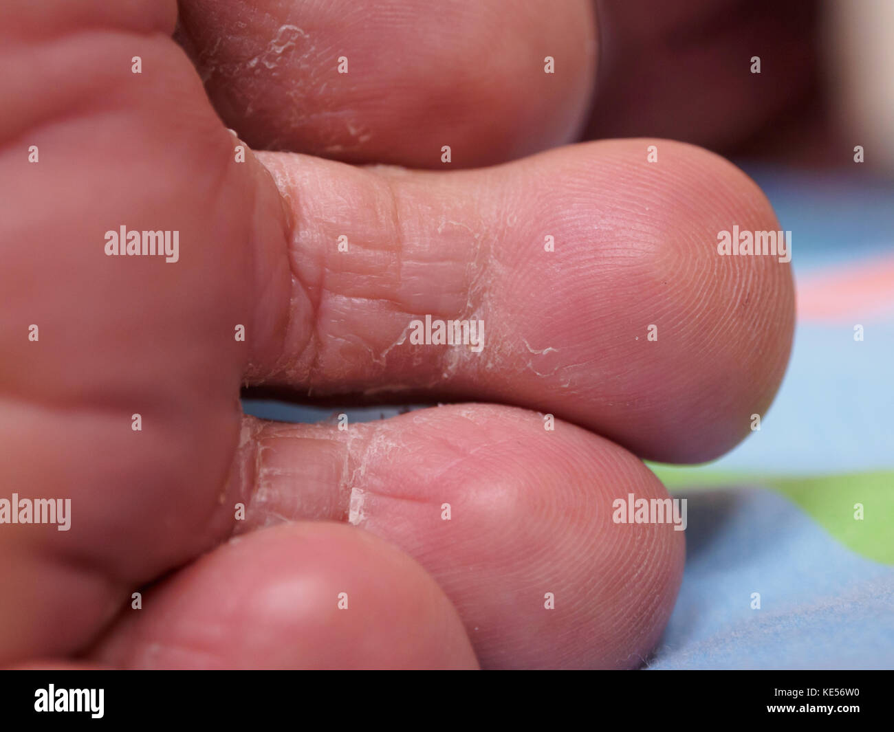 Enfermedad del pie de atleta fotografías e imágenes de alta resolución